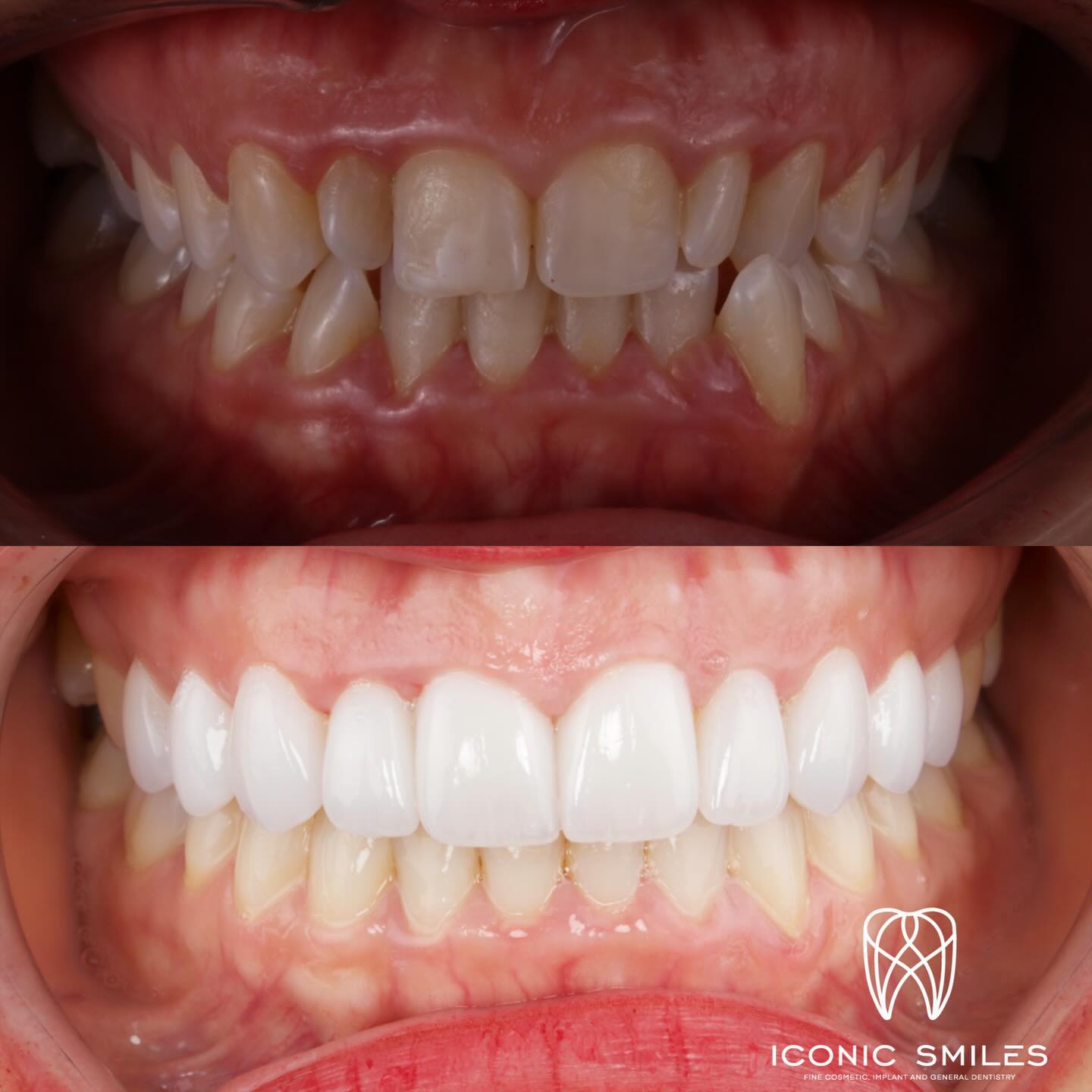 🌟Porcelain Veneers 🌟
Porcelain veneers are not all the same! We have added natural details to the veneers and a glass like finish to the veneers to finish with this rejuvenating smile.
DISCLAIMER
All information provided by Dr Matthew El Azzi - DEN0001996783, Registered Dentist, is for general and educational purposes only. It does not constitute medical advice and should not be relied upon as a substitute for professional consultation.
Images and videos are of real patients who have given consent. No filters, AI enhancements, or unrealistic lighting are used. These materials are intended to demonstrate examples of treatment but do not guarantee results. Individual results, risks, potential complications, and recovery times vary between patients.
Patient stories are individual experiences and should not be interpreted as indicative of expected outcomes for all patients. Your experience may differ.
Before commencing any treatment, you should seek independent advice from a qualified, AHPRA-registered health practitioner and consider obtaining a second opinion.
For details about each specific treatment, head to:
https://www.iconicsmiles.com.au
Dr Matthew El Azzi - DEN0001996783
Registered Dentist, General Registration