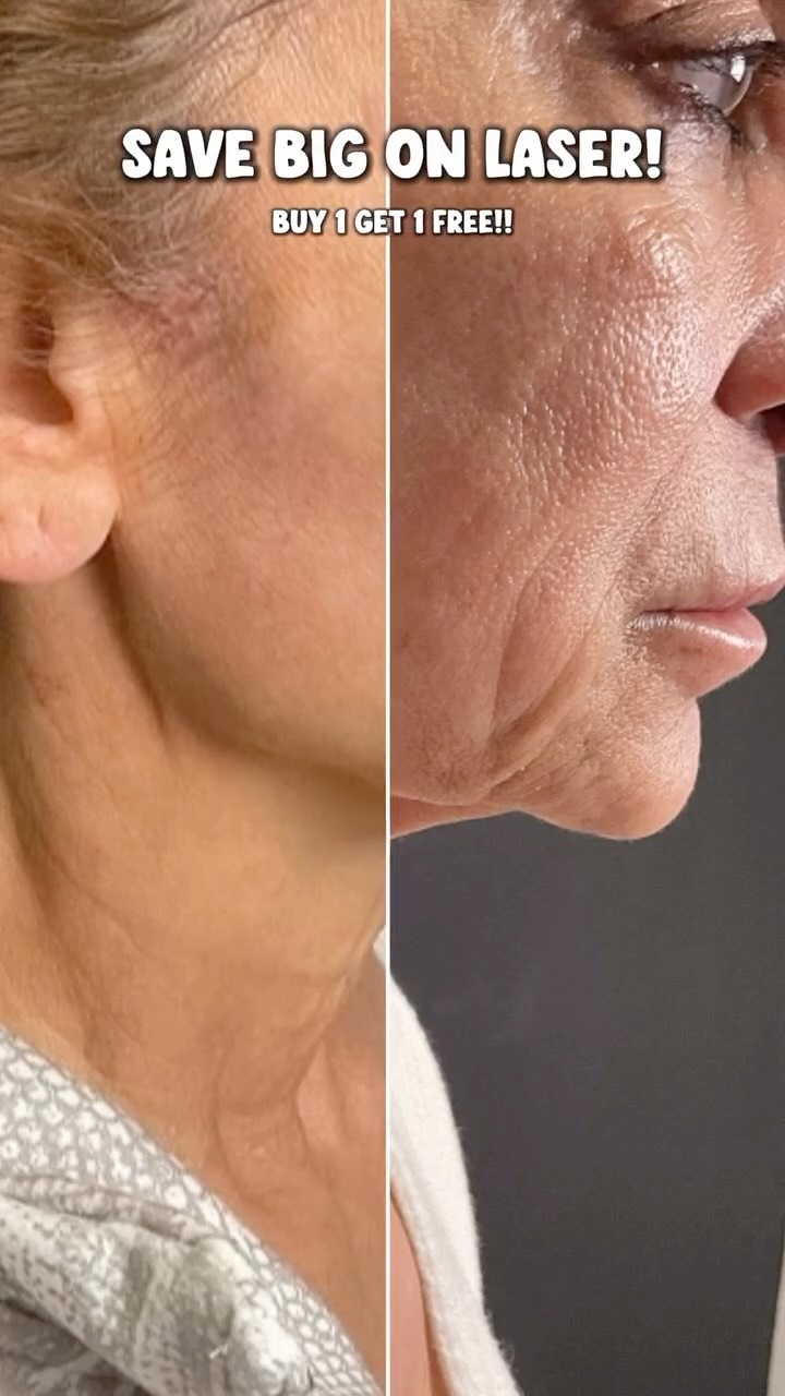 Lift. Tighten. Rejuvenate. ✨
Ready for skin that looks smoother, firmer, and refreshed without surgery? Our advanced laser treatments stimulate collagen, improve texture, fade dark marks, and restore that youthful glow from within.
This is not just a facial. This is skin remodeling.
If you’re dealing with acne scars, uneven tone, fine lines, or ingrown hair marks, laser is the reset your skin has been waiting for.
Glow smarter. Age confidently. Elevate your skin.
Book your consultation today and let’s build your best skin yet. ✨
#LaserRejuvenation #SkinTightening #GlowUp #ClearSkinJourney