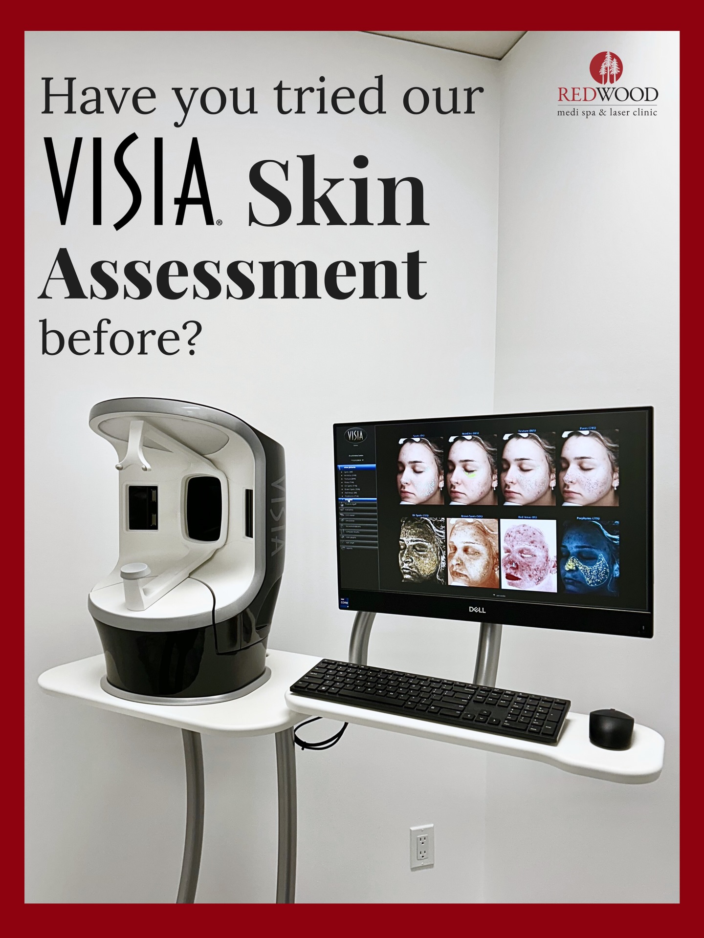 Most skin concerns start below the surface.
VISIA® Skin Analysis is our 7th generation imaging system that shows what the eye can’t see. It evaluates wrinkles, texture, pores, red areas, brown spots, UV damage, porphyrins, and underlying pigmentation in detailed left, right, and frontal views. 🔎
You see your results immediately on screen!
Your first scan becomes your baseline. From there, we track real progress over time so you can actually see how your treatment plan is working.
Every proper skin journey should start with data.
VISIA® consultation is complimentary as part of your personalized treatment plan. Try yours out today! 💆♀️
📍 4141 Yonge St, Unit 304, Toronto, ON M2P 2A6
📞 (416) 481-2888
📩 info@redwoodmedispa.com
#visia #skinanalysis #skincaretreatment #torontomedispa #redwoodmedispa