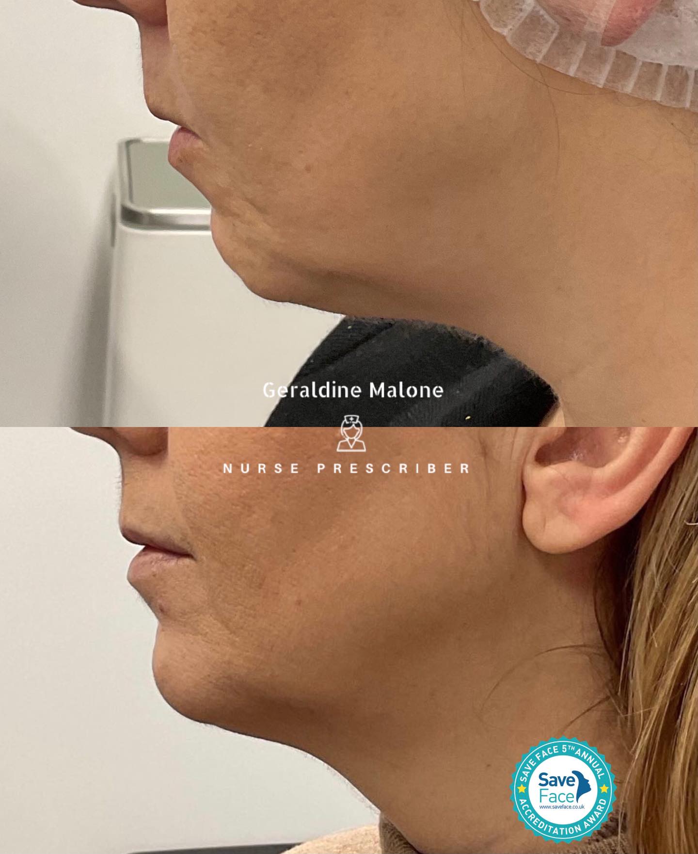 Lower face transformation - High Intensity Focused Ultrasound Treatment (8D HIFU)
✨12 weeks progress and still improving over next 3 months
A more sculpted jawline and refined lower face achieved primarily through advanced 8D HIFU.
8D HIFU delivers focused ultrasound energy deep beneath the skin to stimulate collagen, firm lax tissue, and redefine facial contours — with no surgery and no downtime.
- Results: Gradual improvement over 12-24 weeks
- Lasting: 12–18 months.
- Recovery: Minimal to none
✨All treatments are carried out by Nurse Prescriber Geraldine Malone in a Save Face Registered Clinic, ensuring the highest standards of medical aesthetics, safety, and professionalism.
Contact Us:
📍 CV6 1EB
☎️ 024 7792 1812
📧 geraldinemaloneaesthetics@outlook.com
👉https://www.geraldinemalone.co.uk