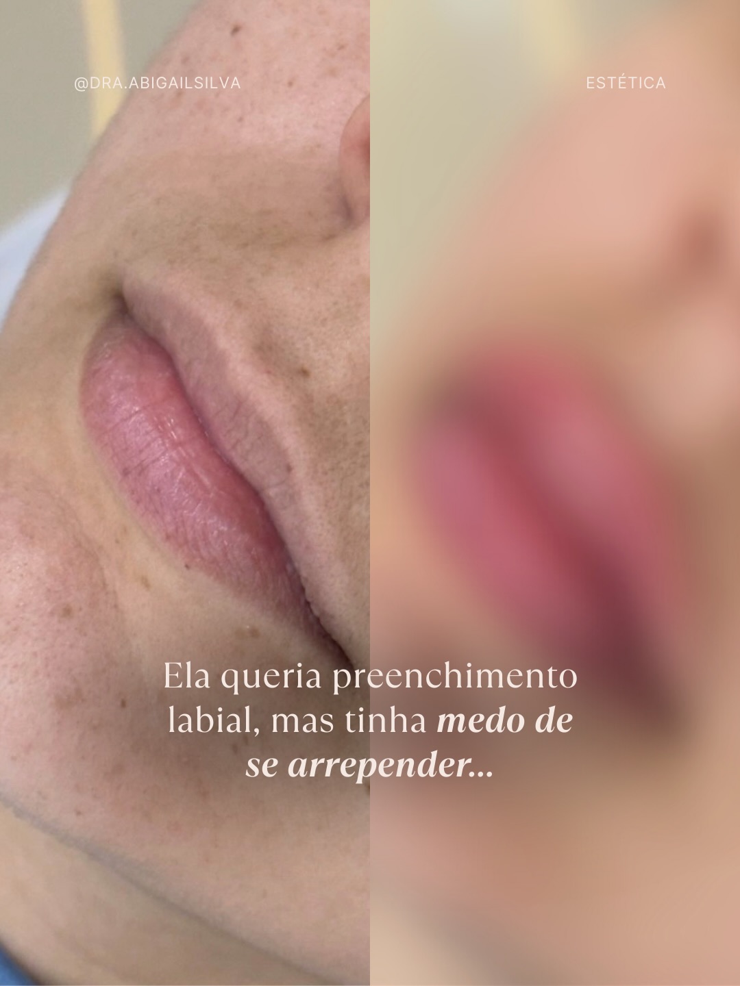 Quando o lábio é pensado perfeitamente para o seu rosto é amor à primeira vista ❤️💋 sem exagero, com naturalidade, realçando a sua beleza!
Se você quer fazer esse procedimento como minha modelo, tendo vantagens de valor no procedimento 👀💰comenta aqui EU QUERO!