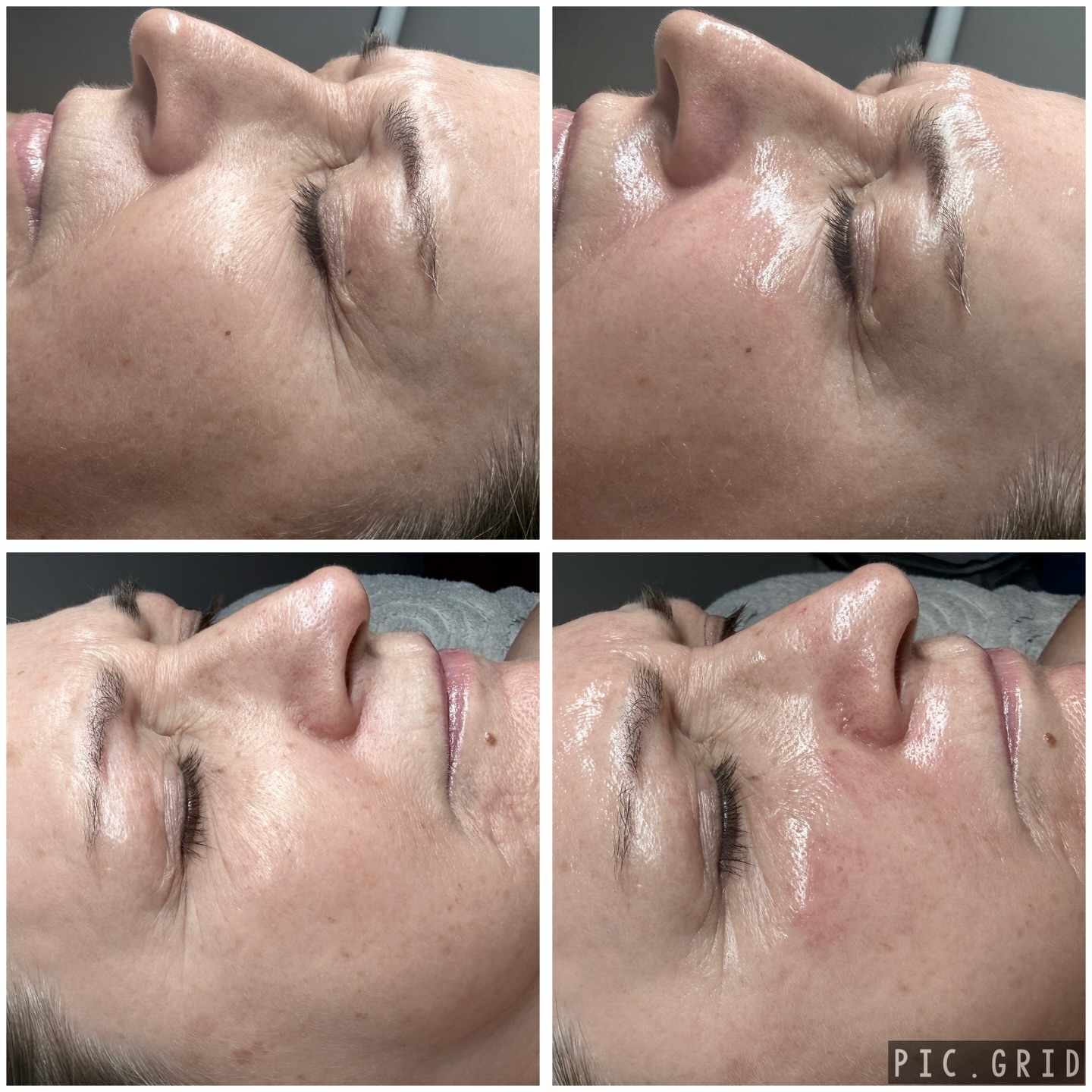 No peel, all glow ✨ A powerful Circadia treatment designed to boost collagen, brighten skin, and restore a youthful glow—without the peeling. This was after the 1st appointment for these clients. Wait until you see the results after 4-6 monthly treatments! 😊 Book your tier 3 facial today! 🔗 Link in bio!