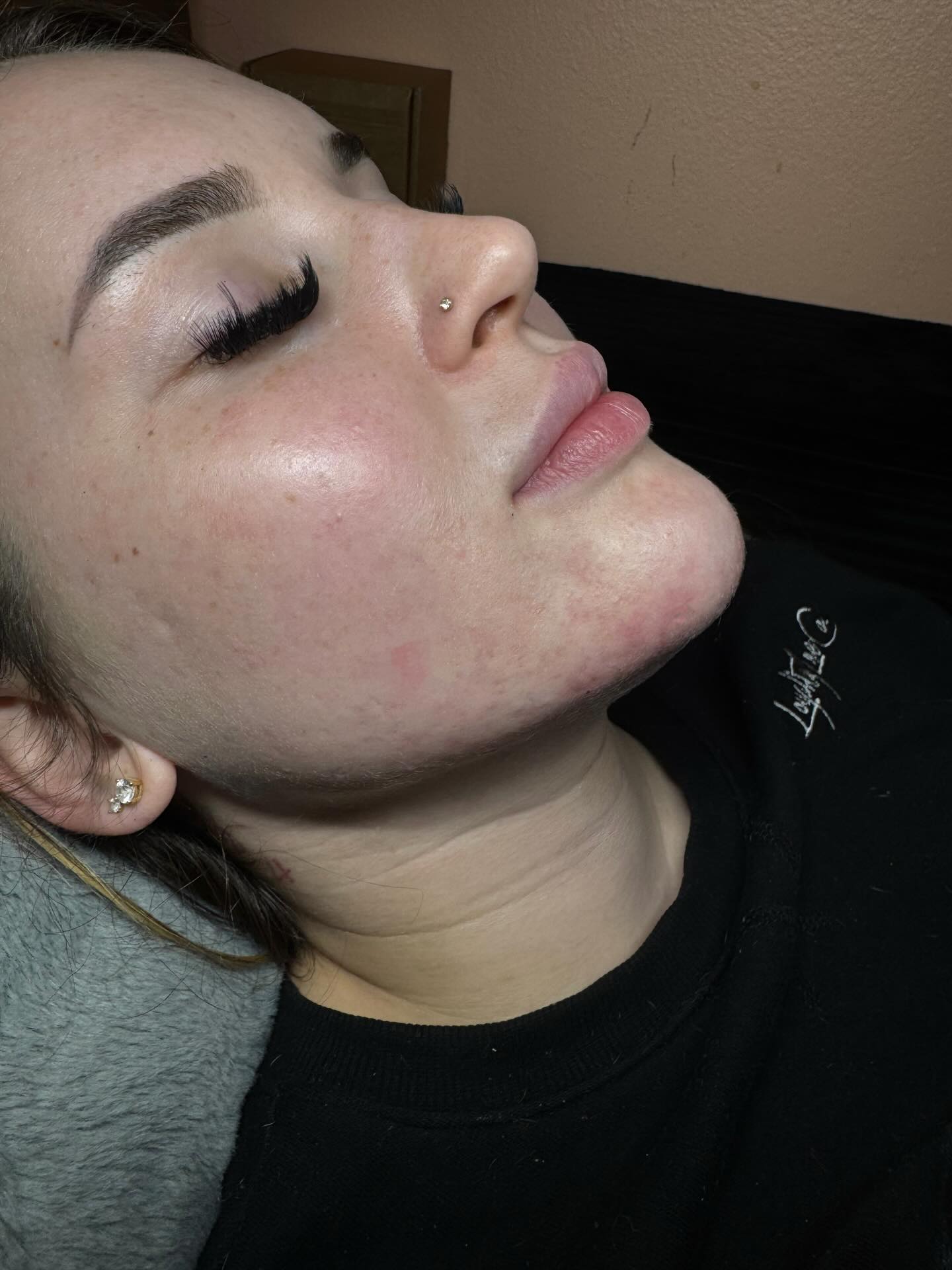 Chin filler results 😍🤏🏾 1 year touch up 💉😍 1mL injected !! Clink link in bio for booking info 💕 #chinfiller #jawlinefiller #facialbalancing #lipfiller #lashes