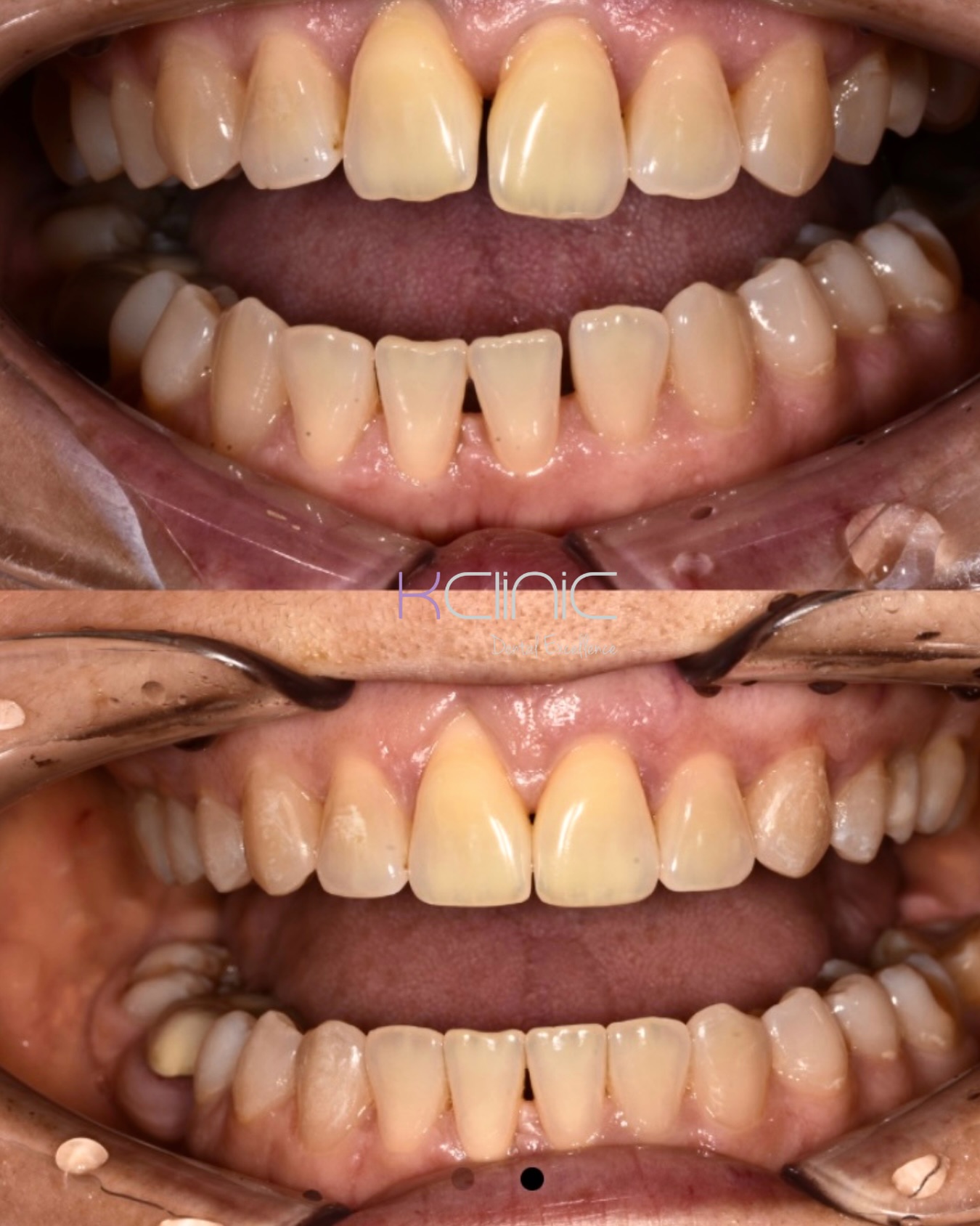 Here’s how to get the best results with your aligners 🤍
✔️ Wear them for 20–22 hours a day
✔️ Clean them regularly with lukewarm water and a soft brush
✔️ Take them out before eating or drinking anything except water
✔️ Brush and floss after meals before putting them back in
✔️ Always store them in their case when not in use
Taking good care of your aligners = a healthier smile and faster results 🦷
Ready to start your smile journey?
Book your free consultation with @ortho_mlp
0 % Finance options available
📍7 Windsor Way, Knutsford WA16 6JB
🌐 www.kclinic.co.uk
📱 07946 219 539
☎️ 01565 653480
#orthodontist#angel#aligners#freeconsultation#dentalmonitoring