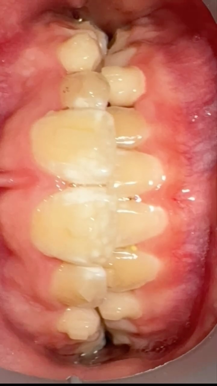 ✨ Smile transformation in progress ✨
Our patient is currently undergoing orthodontic treatment with Angel Aligners Kids, and the results are already visible – even though the treatment is not finished yet!
Step by step, we are guiding the teeth into their ideal position for a healthier bite and a more confident smile.
At K Clinic, Dr Marcin Piekara focuses on precision, comfort, and long-term results — helping patients achieve healthier bites and naturally beautiful smiles.
💎 Discreet aligners
💎 Individual treatment approach
💎 Visible results step by step
✨ We offer FREE orthodontic consultations with Dr Marcin Piekara – book yours today!
0 % Finance options available
📍7 Windsor Way, Knutsford WA16 6JB
🌐 www.kclinic.co.uk
📱 07946 219 539
☎️ 01565 653480
#kids#angelaligner#smiletransformation#orthodontics#preventativecare