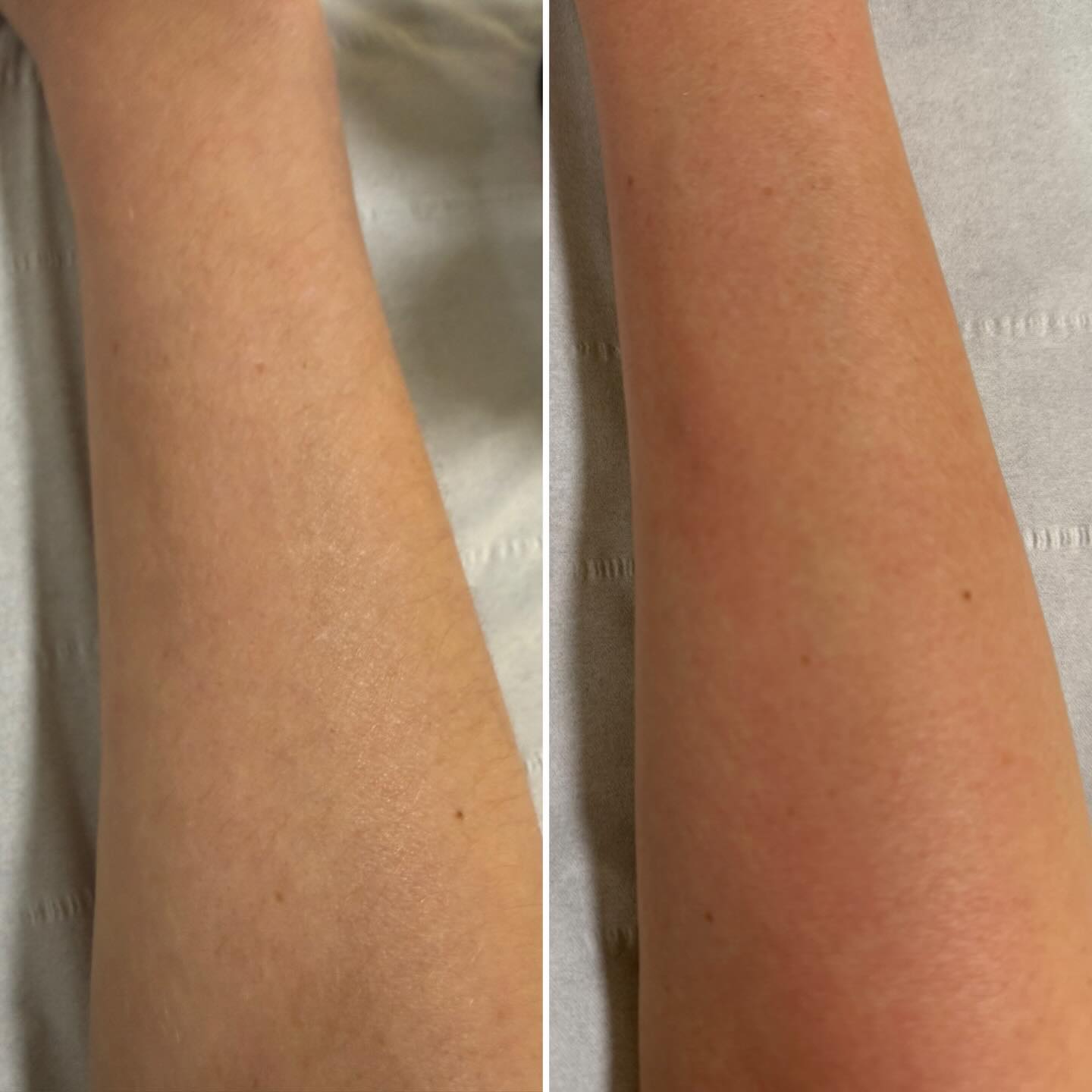 ⭐️Arm Wax⭐️
This is such an underrated treatment, arm waxing removes hair and dead skin leaving the arms soft and smooth.
@glambeautyandaesthetics #smooth #arms #hair #removal #deadskin