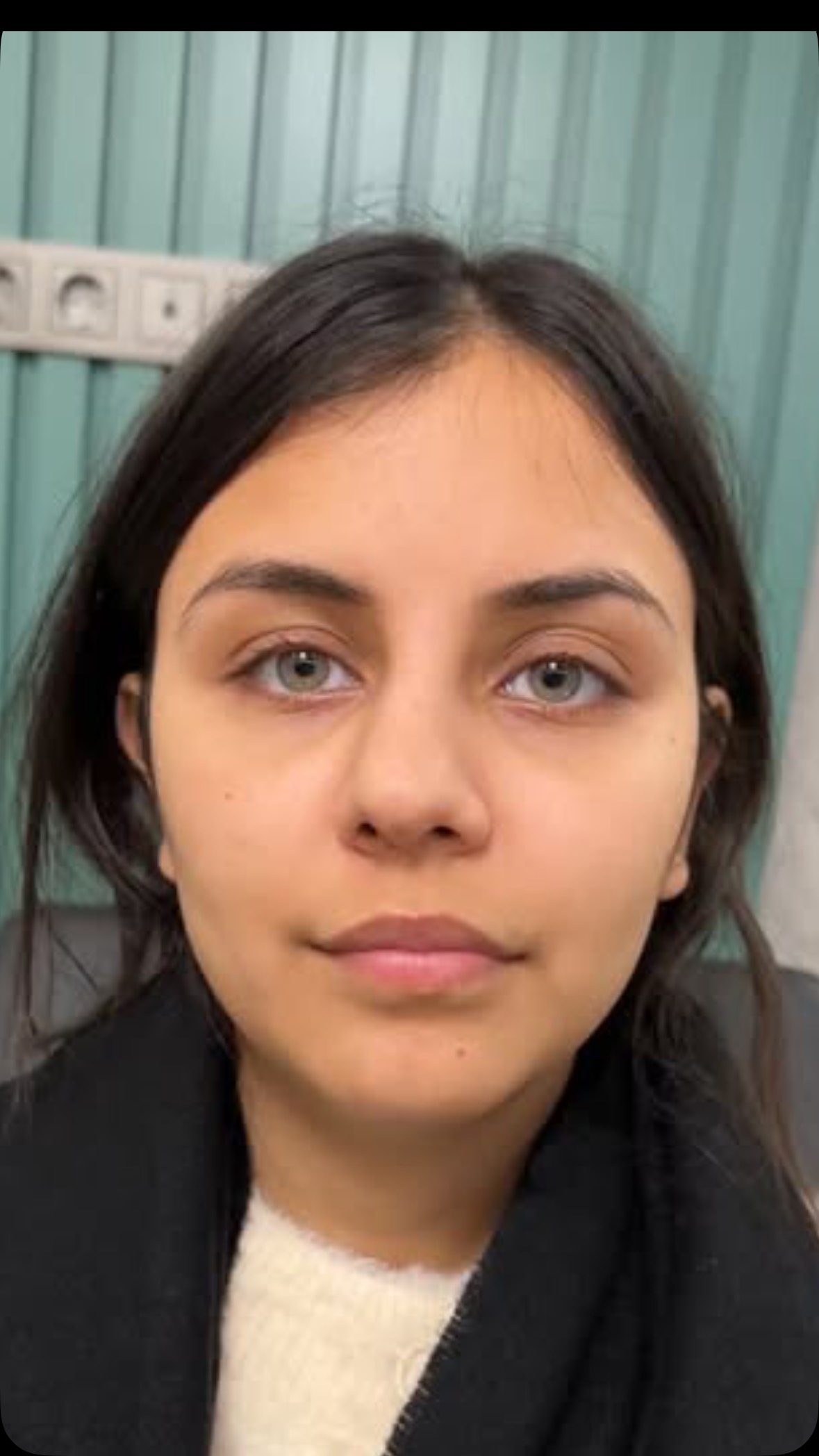 Crooked nose correction⭐️