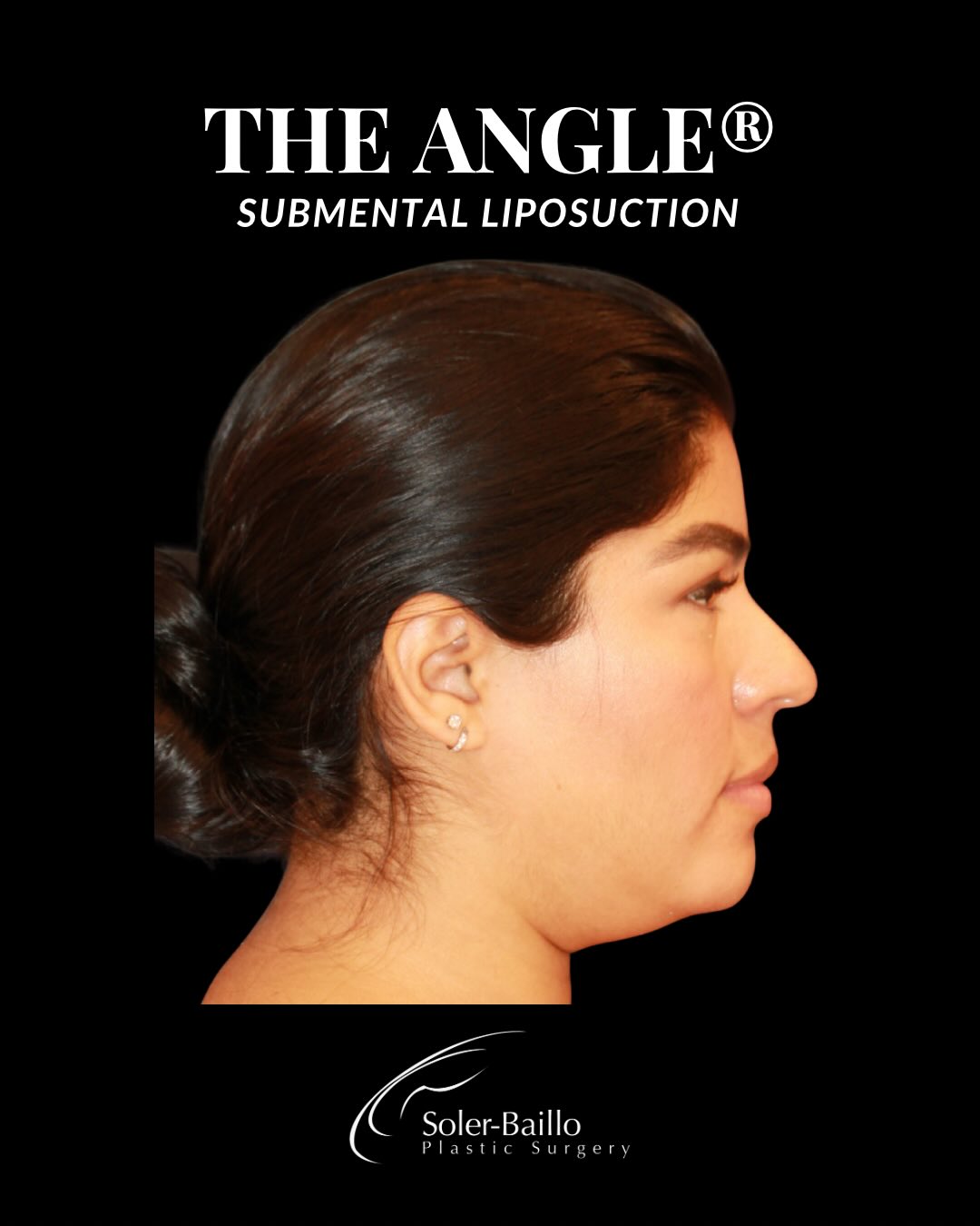 ✨Precision contouring. Thoughtful technique.
The Angle® - Dr. Soler-Baillo’s signature approach to submental liposuction.
💉Submental liposuction targets excess fat beneath the chin to refine the jawline and enhance natural definition. By carefully sculpting this area, we create a smoother transition from chin to neck - restoring balance and structure to the lower face.
📩 Contact us to learn more!
☎️ 305.661.1996
#chinliposuction #submentalliposuction #beforeandafterchinliposuction #chinlipo #chinlipomiami