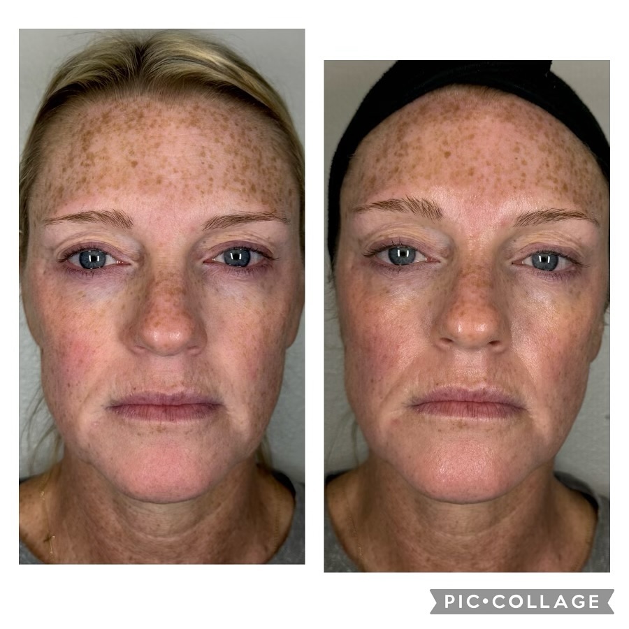 A very exciting January post! This is the Needle Free Filler Facial. In this case, we filled in hollowness under eyes, lifted jowls, and filled in frown lines. The filler facial is a great option for anyone searching for a fresh, lifted look!
Book now for results like these🤩
~All info in bio~