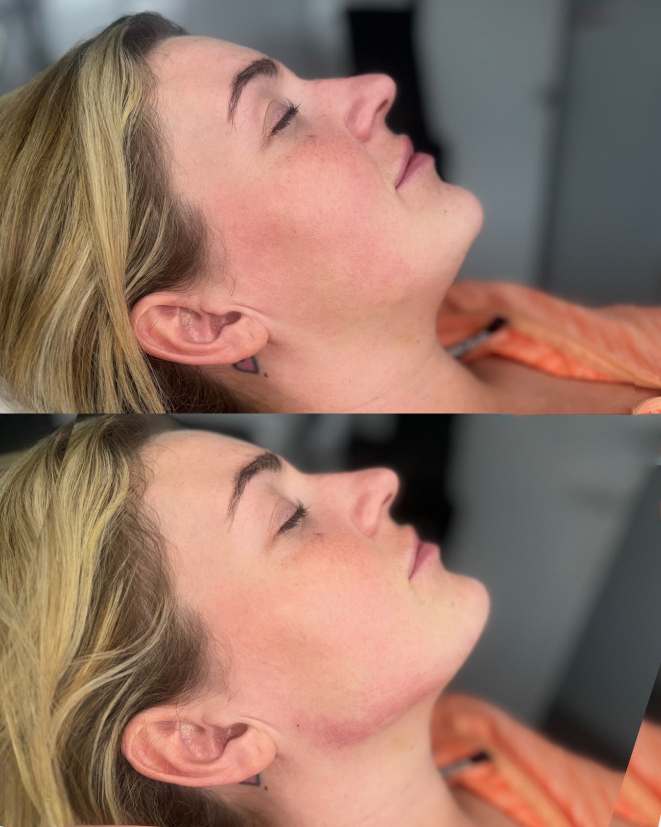 Another day, another snatched queen
The power of the jaw + chin filler combo when it’s placed properly!
A few strategic tweaks can:
• Sharpen your structure
• Add definition
• Balance your side profile
• Snatch without looking “done”
It’s all about working with your face, not against it — subtle, tailored, and mapped to you only to enhance your natural beauty.
📍 Ultra Aesthetics, Liverpool
📲 DM to book your consultation
🔗 Book via the link in bio