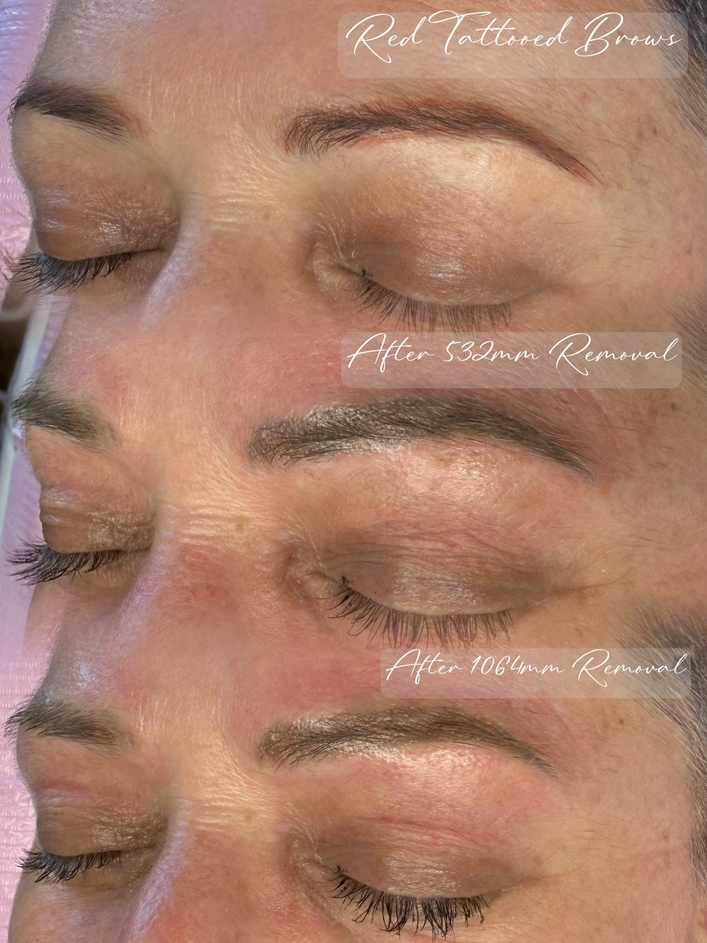 🙋♀️ Whoever have tattoo Brows fade to red, bright red, orange and want to remove and turn them too Brown shade! Then book for 1 removal session with us!!! We can make a change after 30 mins!
👩💻 Www.Fabulashbrows.co.nz
.
.
#eyebrowtattooedremoval #tattooremoval #nz #nzbeauty #pmu