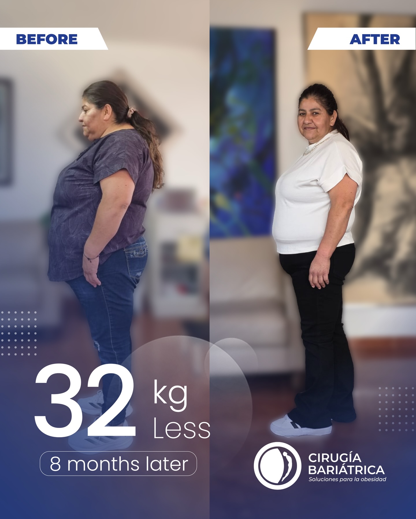 32 kilos menos en 8 meses, pero sobre todo… una nueva calidad de vida ✨ Gracias a la cirugía bariátrica del Dr. Bolaños y su increíble equipo de trabajo, tecnología de punta y un acompañamiento lleno de profesionalismo, hoy esta paciente celebra un cambio que va más allá de lo físico: más salud, más energía y más confianza para vivir su mejor versión.
70 lbs down in 8 months — but even more importantly, a whole new quality of life ✨ Thanks to bariatric surgery with Dr. Bolaños and his amazing team, cutting-edge technology, and true professionalism, this patient is celebrating a transformation that goes far beyond the physical: better health, more energy, and renewed confidence to live her best life.
#bariatricsurgery #weightlosssurgery #bariatrica #bajardepeso #bypass