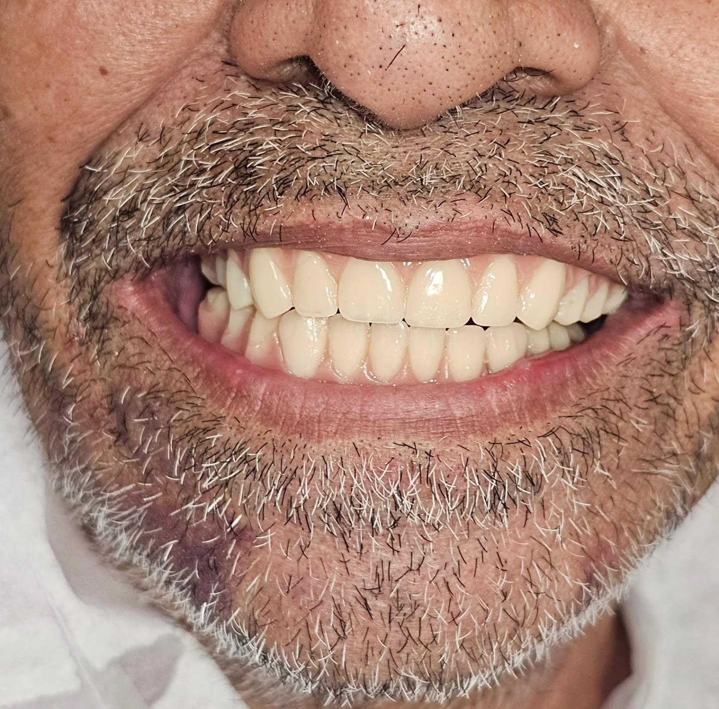 Restoring function and confidence for a 70 years male patient by Full arch rehabilitation using All on 4 concept, all within 3 days!
Precise, Pleasant and Aesthetic, Digital Dentistry!