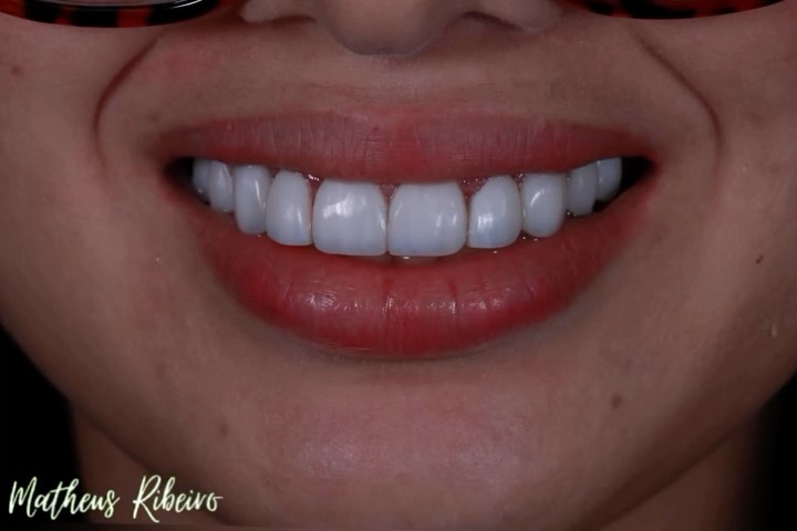 Mais um trabalho finalizado, restaurando o sorriso, transformando a vida!!