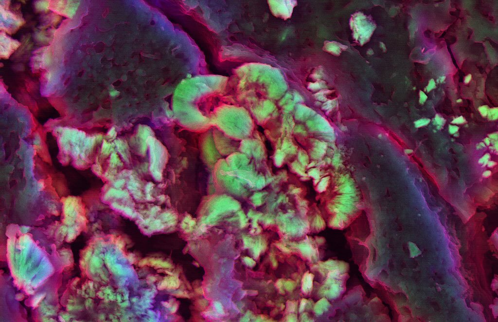 Kidney stones
#science #electronmicroscope #laboratory #scienceart #sciencephoto #scientific #scienceweek #research #lab #micro #microscope #microscopy #medicine #medicalsciencestudent #medicalstudent #mineralomics #bio #biology #bioimaging #biologylab #minerals #chemistry #engineering #physics #sciencecommunication #ucl #DDCSEM #Mineralomics