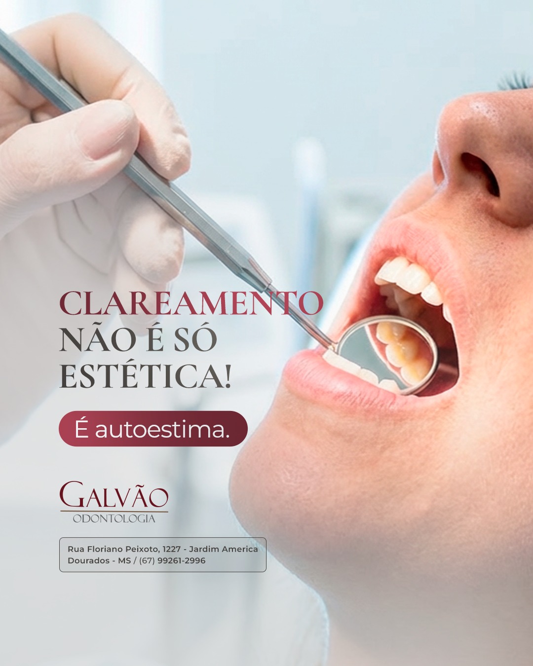 Muita gente associa o clareamento dental apenas à estética.
Mas, na prática, ele vai além da aparência.
Manchas nos dentes podem estar relacionadas a hábitos, acúmulo de placa, desgaste do esmalte ou até restaurações antigas. Antes de clarear, é fundamental avaliar a saúde dos dentes e das gengivas para garantir um resultado seguro e uniforme.
Quando bem indicado, o clareamento contribui para a autoestima, para a confiança ao sorrir e também para a manutenção da saúde bucal, já que exige acompanhamento profissional e cuidados específicos antes, durante e depois do procedimento.
Cada sorriso reage de um jeito. Por isso, o clareamento precisa ser planejado de forma individual, respeitando limites, expectativas e a saúde bucal de cada paciente.
Aqui na Galvão Odontologia, o clareamento é indicado com responsabilidade, buscando sempre um resultado natural e seguro.
📲 Agende seu horário na Galvão Odontologia: (67) 99243-1904
📍 Rua Floriano Peixoto, 1227 – Esquina com a Rua Monte Alegre – Jardim América, Dourados – MS
#dentista #odontologia #dourados #douradosms #clareamento