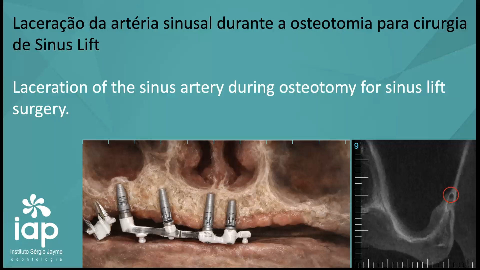 Laceração da artéria sinusal durante a osteotomia para cirurgia
de Sinus Lift
Laceration of the sinus artery during osteotomy for sinus lift
surgery.
A artéria alveolar superior posterior (AASP), frequentemente chamada de "artéria sinusal", é um ramo da artéria maxilar que percorre a parede lateral do seio maxilar. Sua identificação é crucial em cirurgias de levantamento de seio (sinus lift) para evitar hemorragias e garantir o sucesso do enxerto.
Localização: Ela se anastomosa com a artéria infraorbital e possui um ramo intraósseo que passa pela parede lateral, exatamente onde a "janela lateral" é confeccionada para o acesso ao seio.
Risco de Hemorragia: Se o diâmetro da artéria for superior a 1 mm, o risco de sangramento profuso durante a osteotomia aumenta significativamente, o que pode dificultar a visualização da membrana de Schneider e a inserção do material de enxerto.
Variação Anatômica: A distância entre a artéria e a crista do rebordo alveolar varia. Em seios muito pneumatizados, ela pode estar mais próxima da área de incisão.
Planejamento e Manejo
1. Exames de Imagem: A tomografia computadorizada de feixe cônico (Cone Beam) é o padrão-ouro para localizar a artéria, medir seu diâmetro e avaliar sua distância em relação ao assoalho sinusal antes da cirurgia.
2. Técnica Cirúrgica: Se a artéria for detectada no trajeto da janela, o cirurgião pode optar por:
1. Desviar a janela: Posicionar a abertura lateral ligeiramente acima ou abaixo do vaso.
2. Isolamento: Afastar cuidadosamente o vaso se ele estiver aderido à membrana de Schneider após a osteotomia.
3. Controle de Sangramento: Caso ocorra o rompimento, utiliza-se pressão local, cera óssea ou agentes hemostáticos para controlar o fluxo e prosseguir com a instalação do implante ou enxertia.
Esse caso foi executado no IAP-Sérgio Jayme
Dr. Sérgio Jayme Av. Paulista, 91 Cj 402 Tel (11)5572-1283 / Cel e WhatsApp (11)94888-2000 CEP:01311-000 São Paulo-SP
Av. Rubem Berta, 1461 Tel (11)2276-2217 / Cel e WhatsApp (11)98383-3941
CEP: 04074-010 São Paulo-SP
#implante #curso #rog #cytoplast #enxertoosseo #enxerto #iap #rog #regeneracaoosseaguiada #enxerto #enxertoosseo#sergiojayme #sergiojaime #ci