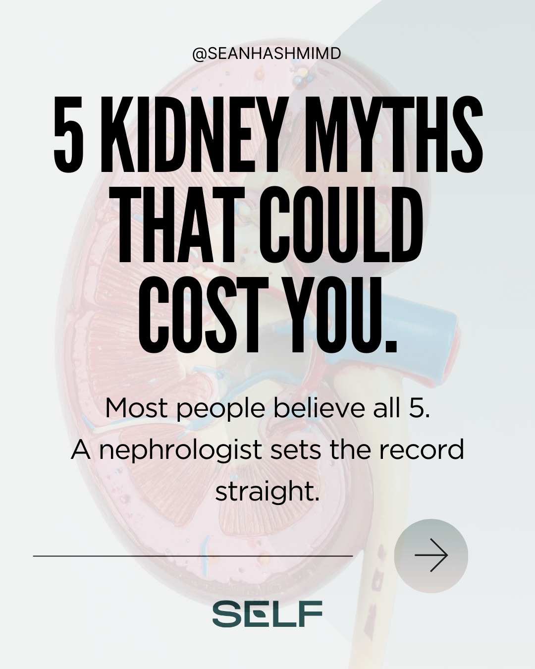 Most people believe at least 3 of these.
I'm a board-certified nephrologist, and I hear these myths from patients every single week. Some of them seem harmless. Others could delay a diagnosis by years.
Here are 5 kidney myths I need you to stop believing:
1. "Drinking more water is always better for kidneys." (Aim for light lemonade-colored urine instead.)
2. "Kidney disease only happens to older people." (6% of adults aged 18-44 already have CKD.)
3. "Normal labs mean healthy kidneys." (You can lose 50% function with normal creatinine.)
4. "Protein is bad for kidneys." (Context matters more than blanket rules.)
5. "Kidney disease means dialysis." (Most early-stage patients never need it.)
The earlier you know the truth, the more options you have.
Save this. Share it with someone who needs it.
Key References
National Kidney Foundation. What the Color of Your Urine Means. kidney.org
CDC. Chronic Kidney Disease in the United States, 2023. Atlanta, GA: US DHHS; 2023.
KDIGO. (2024). KDIGO 2024 Clinical Practice Guideline for CKD. kdigo.org/guidelines/
Herrington, W. G., et al. (2023). Empagliflozin in Patients with CKD. NEJM, 388(2), 117-127.
Heerspink, H. J. L., et al. (2020). Dapagliflozin in Patients with CKD. NEJM, 383(15), 1436-1446.
Kovesdy, C. P. (2022). Epidemiology of CKD: An Update 2022. Kidney Int Supplements, 12(1), 7-11.
#KidneyHealth #KidneyDisease #CKD #Nephrology #KidneyAwareness #ChronicKidneyDisease #KidneyDoctor #HealthMyths #MedicalMyths #EvidenceBasedMedicine #PreventiveMedicine #HealthEducation #DoctorsOfInstagram #Nephrologist #SeanHashmiMD #SELFPrinciple