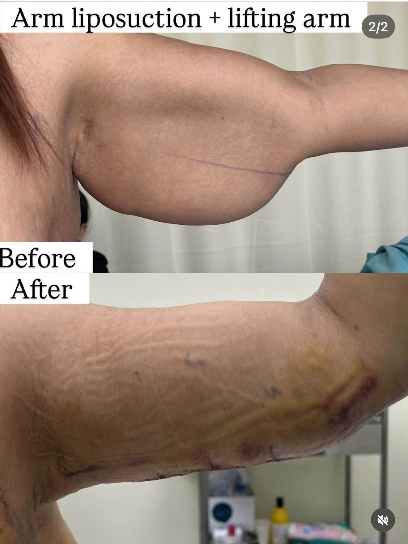 Arm Liposuction + Arm Lifting – Client from Singapore
This client came from Singapore with a very common condition after major weight loss.
She had lost 25 kg in a short period of time, which caused the fat in her arms to reduce quickly, but the skin did not have enough time to retract, leading to loose and sagging upper arm skin.
⸻
Why combine two procedures?
In this case, one procedure alone is not enough.
We performed arm liposuction combined with arm lifting in the same surgery to achieve the best results:
• Arm liposuction: removes excess fat and reshapes the arm contour
• Arm lifting (brachioplasty): removes loose skin and tightens the arm for a firmer appearance
If we only do liposuction, the skin will still look loose.
If we only do lifting without contouring the fat, the arm shape may not look smooth and balanced.
⸻
Results
After surgery and proper post-operative care, she achieved slimmer, firmer, and beautifully contoured arms.
This combination is ideal for patients who:
• Have lost a significant amount of weight
• Have loose or sagging arm skin
• Want a more toned and defined arm shape
⸻
Why do we accompany our clients during surgery?
To achieve results like this, our team stays with the client throughout the entire surgical process, from the start of the operation until it is completed.
Why do we do this?
Because we aim for the best and most perfect results for every client.
• We closely follow the surgical process
• Support communication between doctor and client
• Ensure every step is performed as planned
• Help the client feel safe and confident throughout the journey
This is one of the reasons many international clients choose Vietnam Medical Tourism with R&R Beauty Aesthetic. #armliposuction #liftingarm #plasticsurgeryvietmam #vietnamplastivsurrgery