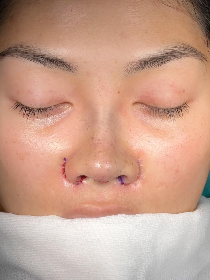 The last photo shows the difference between the alarplasty side and the non-alarplasty side.⭐️
No rib graft, as usual.