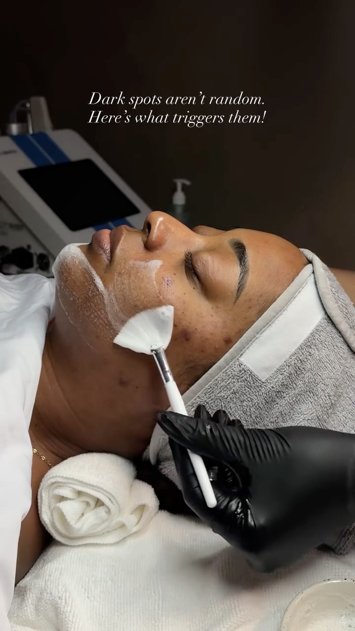 Here’s what triggers it:
• Acne & inflammation
• Hormonal changes
• Over-exfoliation
• Shaving & ingrowns
• Improper treatments for melanated skin
Correcting hyperpigmentation (a.k.a. dark spots, PIH or PIE) requires strategy, timing, and the right peel.
Treatment: MelaPro Even Tone Correction Peel
📍 @dewglowskin
…
#chemicalpeel #acne #darkspotsolution #atlfacials #skinbrightening