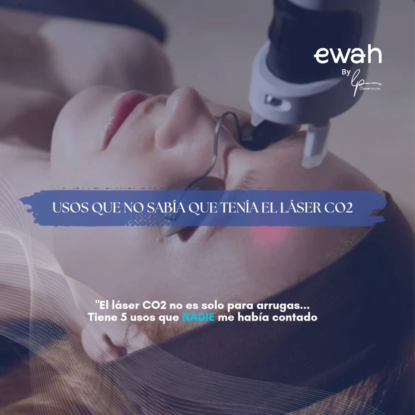 Se habla mucho del láser de CO2, pero aquí te cuento 5 usos del láser CO2 den medicina estética.
1. Rejuvenecimiento facial
2. Eliminación de cicatrices de acné
3. Tratamiento para estrías
4. Eliminación de verrugas y lunares
5. Rejuvenecimiento intimo femenino
De cual tratamiento te gustaría hablar?