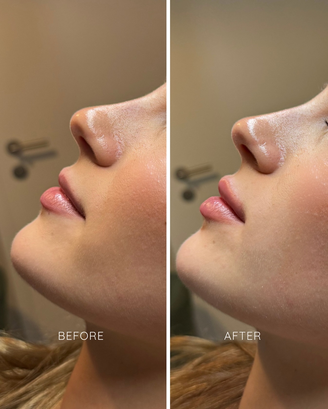 Before and After 👄
Bei dieser Kundin wurden insgesamt 0.7ml verwendet. Das Ergebnis rechts wurde direkt nach der Behandlung aufgenommen, die Lippen sind direkt nach der Behandlung immer etwas angeschwollen.
#lips #lipsonfleek #hyaluron #nuaaesthetics