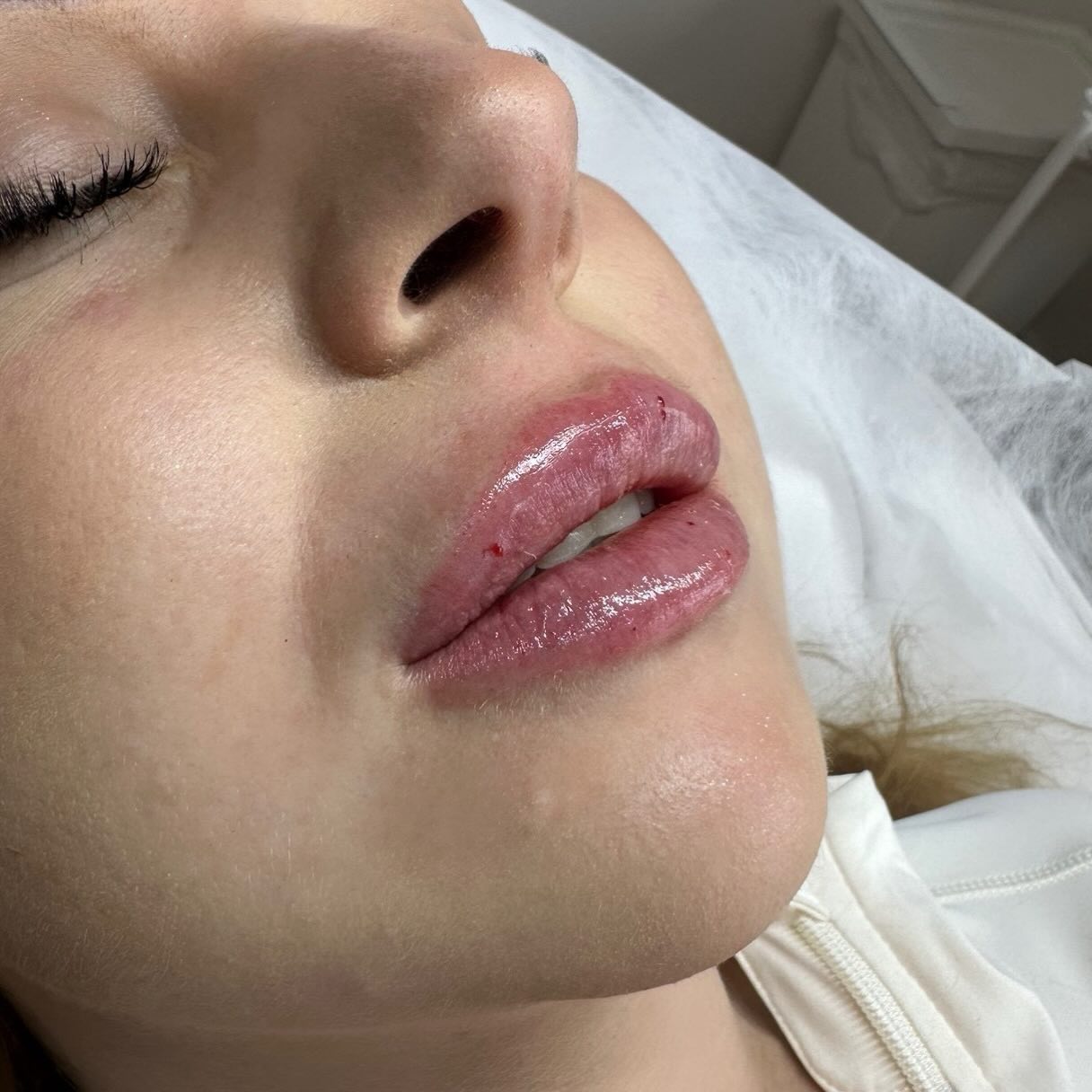 Jede Lippe ist individuell – jede Behandlung hat ein eigenes Ziel💉
Wir orientieren uns an den anatomischen Voraussetzungen und den Wünschen unserer Patient:innen💋
#deincosmetologist #lippen #lipps #tübingen #rottenburg