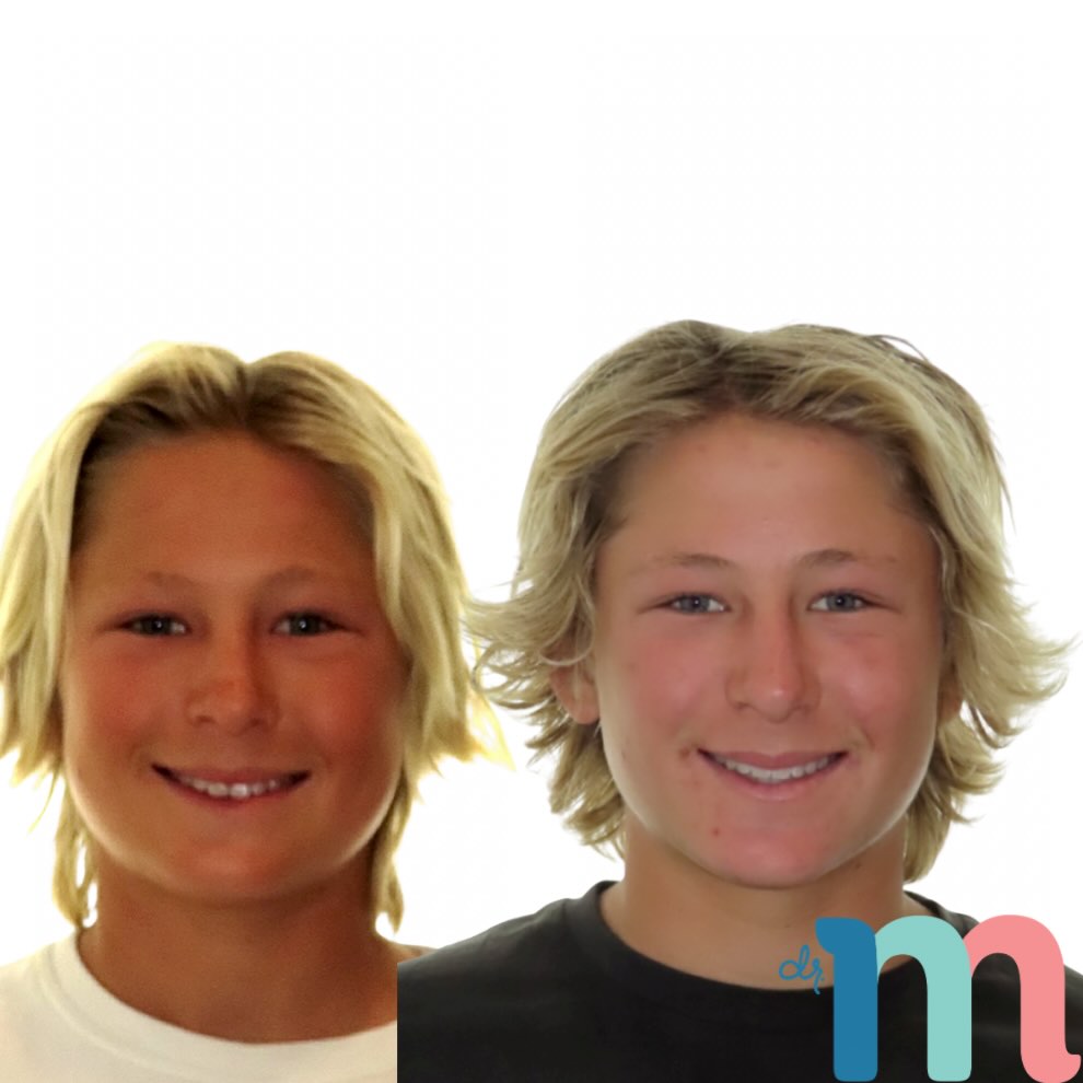 Transformation Tuesday 🦷
A narrow smile can leave dark spaces at the corners of the mouth. By developing the arch and aligning the teeth, we created a wider, more balanced smile that fills the frame naturally
•
•
📍 Huntington Beach | Orange County | California
☎️ (714) 500-7147
🌎 www.messenger-smiles.com
•
•
•
#SmileDesign #OrthodonticResults #ArchDevelopment #BeforeAndAfter #messengerorthodontics