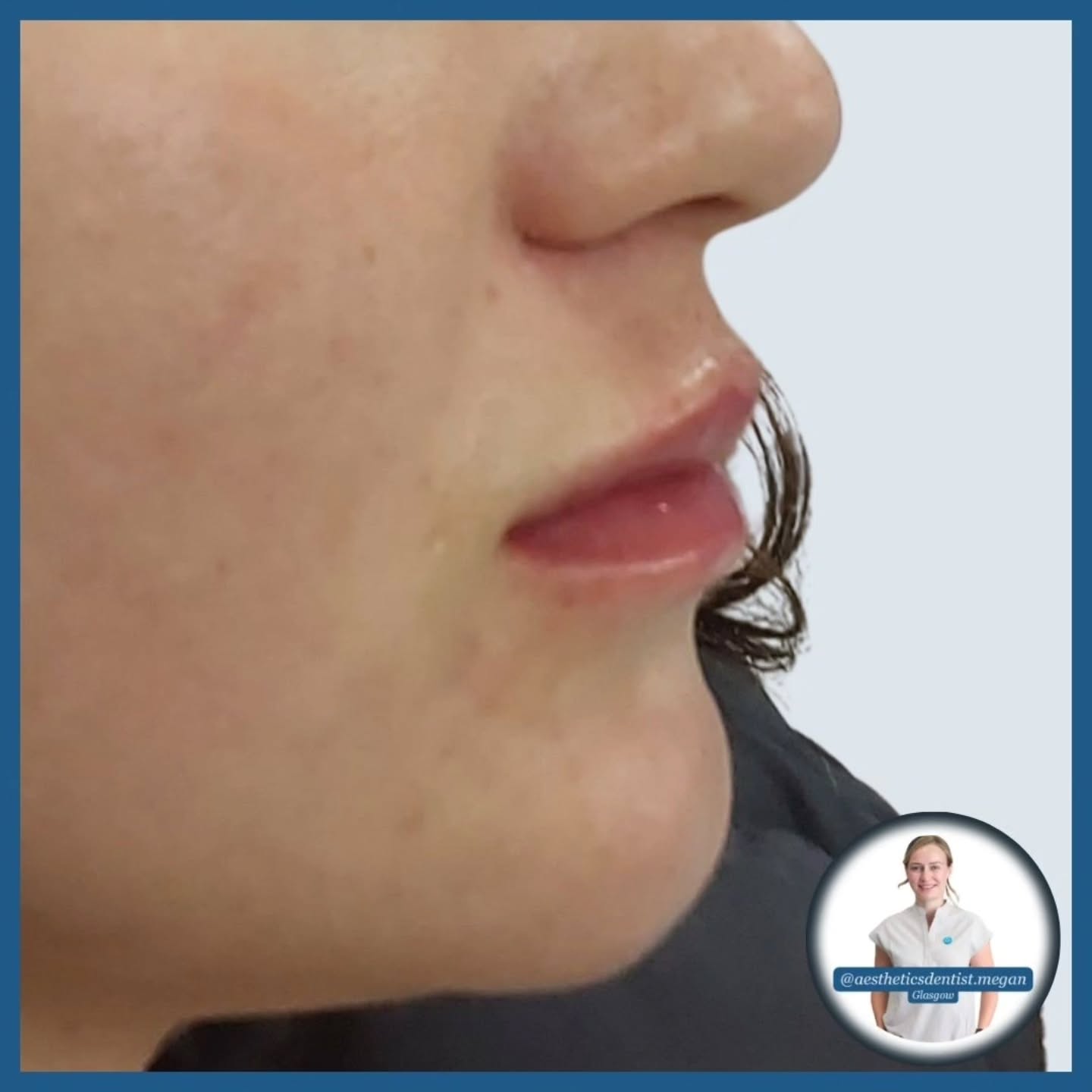 A 14 month lip journey 💋💉
(👉 swipe through)
Slow and steady wins when you're looking to achieve volume & definition in a thinner set of lips
Placing too much filler in one sitting would have inevitably caused some migration
Instead, we did the first session in December 2024, and completed a second session in February 2025
Defined ✅
Voluminous ✅
Perfectly pouty ✅
1.4ml product in total @teoxane_uk
RHA kiss
A side profile to die for, and one that definitely doesn't scream duck beak 🦆
Lips that suit you 💙
Megan x