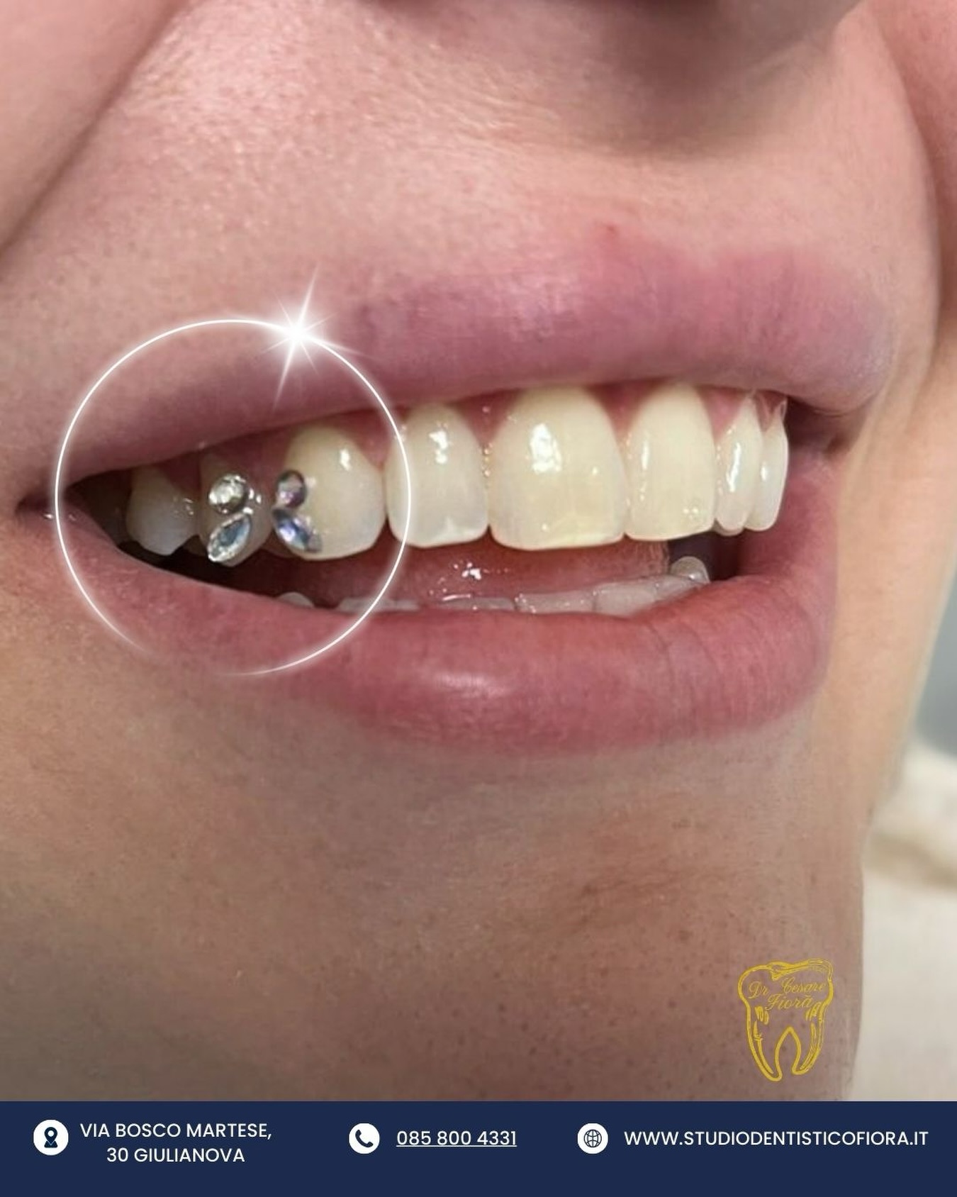 𝐇𝐚𝐢 𝐦𝐚𝐢 𝐧𝐨𝐭𝐚𝐭𝐨 𝐜𝐨𝐦𝐞 𝐛𝐚𝐬𝐭𝐚 𝐮𝐧 𝐝𝐞𝐭𝐭𝐚𝐠𝐥𝐢𝐨?
𝖴𝗇 𝖽𝖾𝗍𝗍𝖺𝗀𝗅𝗂𝗈 𝗉𝗂𝖼𝖼𝗈𝗅𝗈.
𝖴𝗇 𝖾𝖿𝖿𝖾𝗍𝗍𝗈 𝖼𝗁𝖾 𝖼𝖺𝗆𝖻𝗂𝖺 𝗍𝗎𝗍𝗍𝗈 ✨
𝖨𝗅 𝖻𝗋𝗂𝗅𝗅𝖺𝗇𝗍𝗂𝗇𝗈 𝖽𝖾𝗇𝗍𝖺𝗅𝖾 𝖺 𝖿𝖺𝗋𝖿𝖺𝗅𝗅𝖺 𝗂𝗅𝗅𝗎𝗆𝗂𝗇𝖺 𝗂𝗅 𝗌𝗈𝗋𝗋𝗂𝗌𝗈 𝗌𝖾𝗇𝗓𝖺 𝗆𝗈𝖽𝗂𝖿𝗂𝖼𝖺𝗋𝗅𝗈.🦋
𝖲𝖼𝗋𝗂𝗏𝗂𝖼𝗂 𝗈 𝗉𝗋𝖾𝗇𝗈𝗍𝖺 𝖽𝗂𝗋𝖾𝗍𝗍𝖺𝗆𝖾𝗇𝗍𝖾 𝖽𝖺𝗅 𝗇𝗈𝗌𝗍𝗋𝗈 𝗌𝗂𝗍𝗈.
𝐈𝐥 𝐝𝐞𝐭𝐭𝐚𝐠𝐥𝐢𝐨 𝐠𝐢𝐮𝐬𝐭𝐨 𝐥𝐨 𝐝𝐞𝐟𝐢𝐧𝐢𝐚𝐦𝐨 𝐢𝐧𝐬𝐢𝐞𝐦𝐞, 𝐢𝐧 𝐬𝐭𝐮𝐝𝐢𝐨. ✨
𝖲𝗍𝗎𝖽𝗂𝗈 𝖽𝖾𝗇𝗍𝗂𝗌𝗍𝗂𝖼𝗈 𝖥𝗂𝗈𝗋𝖺̀
📍𝖦𝗂𝗎𝗅𝗂𝖺𝗇𝗈𝗏𝖺,𝗏𝗂𝖺 𝖡𝗈𝗌𝖼𝗈 𝖬𝖺𝗋𝗍𝖾𝗌𝖾 𝟥𝟢
📞 0𝟪𝟧.𝟪𝟢𝟢𝟦𝟥𝟥𝟣
𝐃.𝐒. 𝖢𝖾𝗌𝖺𝗋𝖾 𝖥𝗂𝗈𝗋𝖺̀, 𝖠𝗅𝖻𝗈 𝗈𝖽𝗈𝗇𝗍𝗈𝗂𝖺𝗍𝗋𝗂 𝖽𝗂 𝖳𝖾𝗋𝖺𝗆𝗈 𝗇.𝟥𝟧𝟥
#dentistifiora #dentistigiulianova #studiodentisticogiulianova #toothgem
