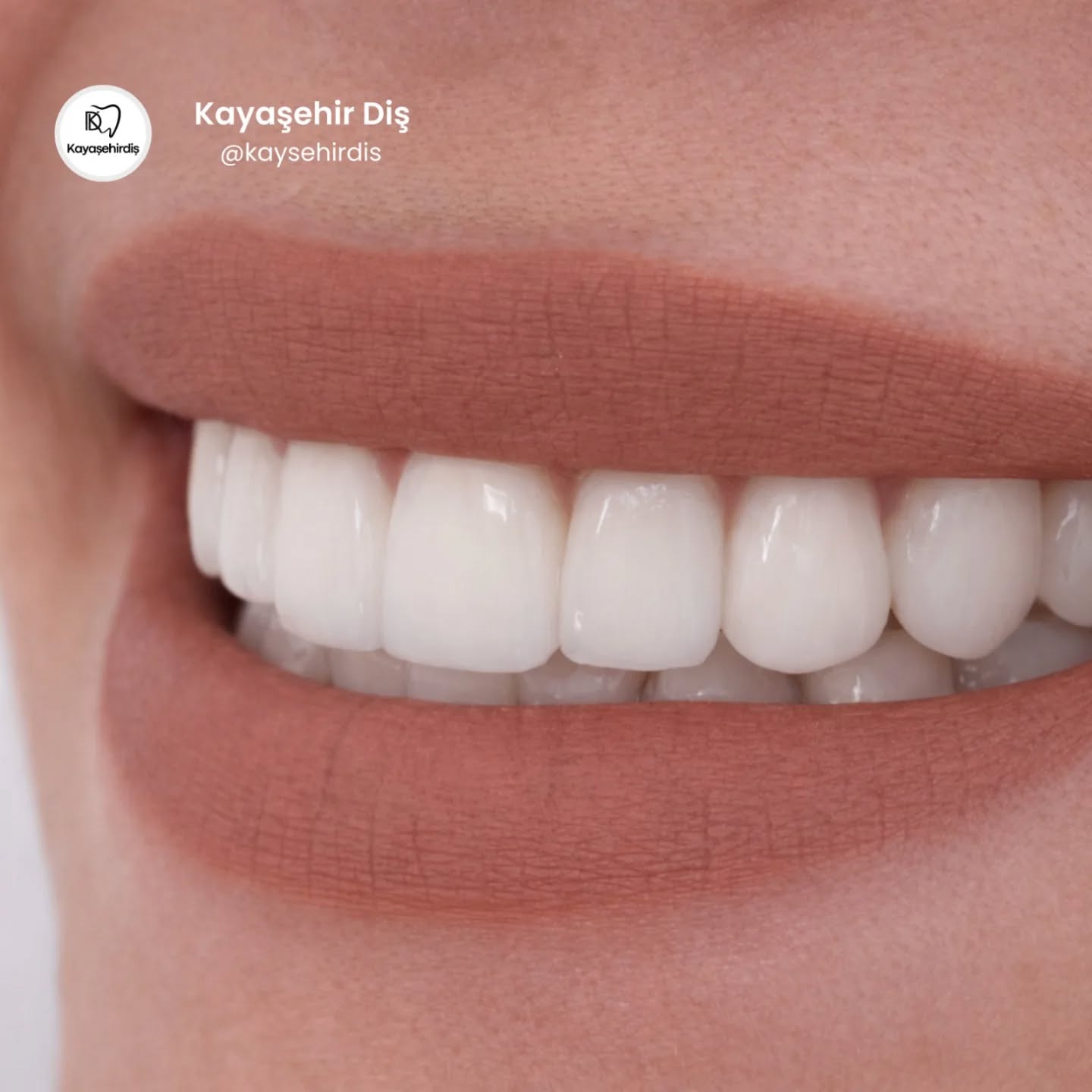 Gülümseme, insanın kendine verdiği en güzel değerdir.
Kayaşehir Diş Kliniği olarak sağlıklı gülüşler için çal