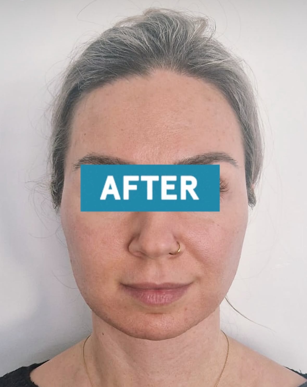 Lapozz az utána képért👉🏽
Kedves páciensünk 6 hónapos eredménye a deep plane face lift és neck lift után.
A teljes gyógyulási idő 12 hónap, de az eredmény már most is gyönyörű és látványos. Az arc visszakapta szép vonalait🤍
DÍJMENTES KONZULTÁCIÓ budapesti irodánkban!
✉️info@esteworld.hu
🌐www.esteworld.hu
☎️ +36704218560
☎️+36704323632
(Viber, Whatsapp és iMessage)
Bátran hívjatok hétköznapokon 10:00-től 16:00-ig.
#esteworld #esteworldmagyarorszag #arcplasztika #arcfelvarras #deepplane #surgicalnet