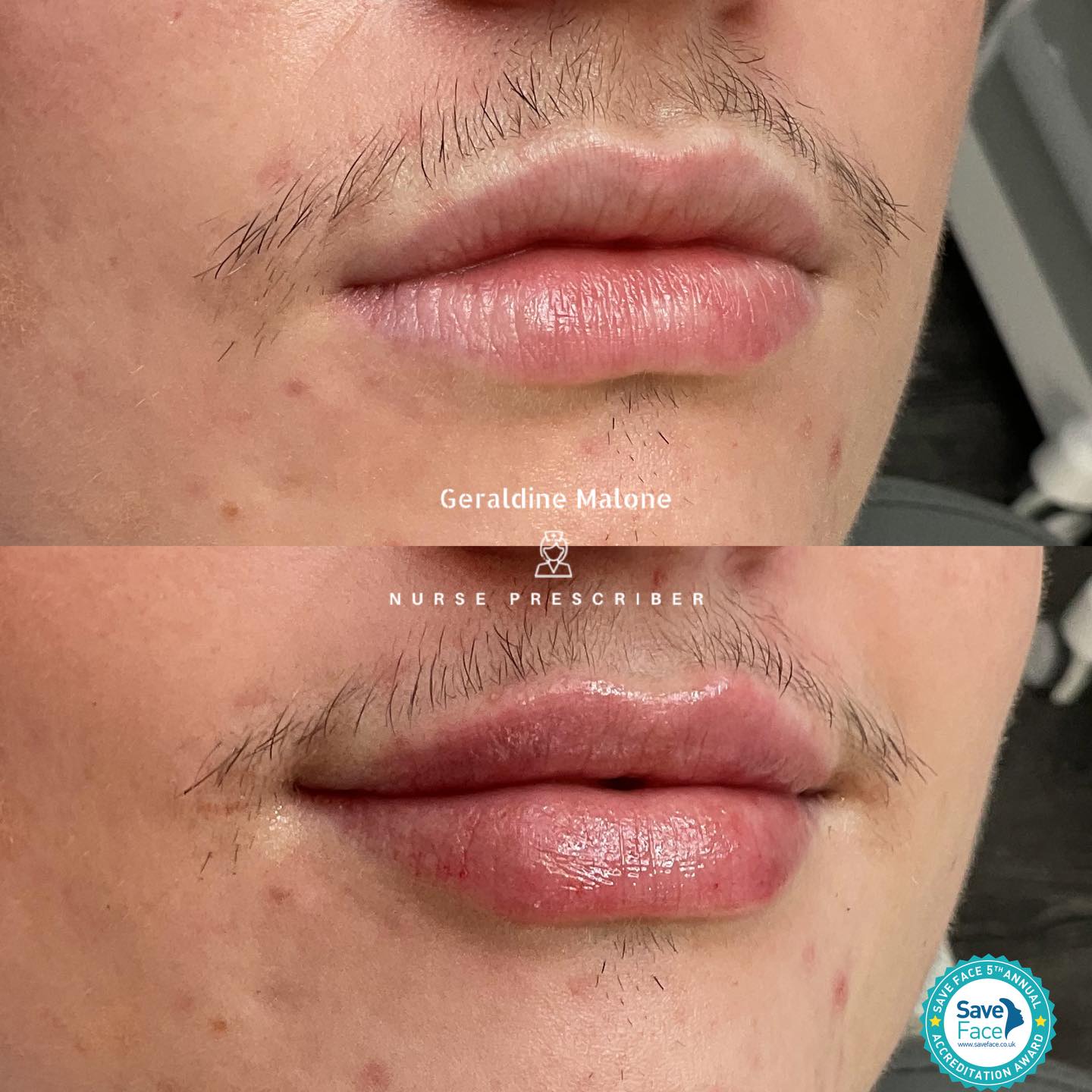 👄Lip Enhancement 👄
Enhance your natural beauty with soft, hydrated lips and beautifully refined volume — carefully tailored to complement your unique shape and facial proportions for a balanced, elegant result.
💉 Treatment price:
0.5ml – £145
1ml – £225
⏱ Recovery: 24–48 hours
⏳ Longevity: 6–12 months
📸 No edited images – real results only
All treatments are performed by Nurse Prescriber Geraldine Malone within a Save Face Registered Clinic, ensuring the highest standards of safety, professionalism, and patient care.
📅 Book your appointment:
👉 www.geraldinemalone.co.uk/book-appointment
📞 Contact us:
☎️ 024 7792 1812
📧 geraldinemaloneaesthetics@outlook.com