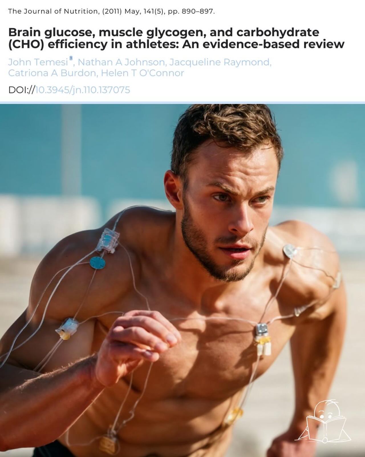 Brain glucose, muscle glycogen, and carbohydrate (CHO) efficiency in athletes: An evidence-based review.
CLAIM: “The Real Performance Driver Is Brain Glucose.”
REALITY: While brain glycogen does contribute to central fatigue, this can be combined with muscle glycogen depletion to limit performance. Both mechanisms work in conjunction with one another and do not act independently.
CLAIM: “CHO Loading Does Not Improve Performance.”
REALITY: Multiple meta-analysis studies have demonstrated that proper CHO intake prior to competition results in an improvement of 2-7.5 % in time trials, and an improvement of 15-54 % in time to exhaustion. The amount of CHO consumed during these types of competitions should range from 30-90 grams per hour during the activity.
CLAIM: “High CHO Diets Reduce Metabolic Efficiency.”
REALITY: Training in a strategic low CHO diet may increase the rate at which an athlete can oxidise fats, however, there has been no significant difference in overall athletic performance when compared to traditional CHO based training methods. CHO remain the most efficient source of fuel for high-intensity activities.
CLAIM: “Endurance Training Causes Insulin Resistance When Consumed On A High CHO Diet.”
REALITY: Conversely, endurance training increases the sensitivity of the body to insulin, allows glucose to enter cells easier, and improves the body’s ability to use different substrates for energy.
EVIDENCE-BASED RECOMMENDATIONS
Pre-competition CHO load of 5-12 grams per kilogram of body weight for events lasting longer than 90 minutes.
During competition CHO intake of 30-90 grams per hour depending on, athlete gender, weight, the intensity and duration of the event.
Use a combination of CHO such as glucose and fructose to optimise CHO absorption rates.
Reference:
Temesi, J. et al. (2011). Carbohydrate ingestion during endurance exercise improves performance in adults. The Journal of Nutrition. 141(5), pp. 890–897. doi:10.3945/jn.110.137075.