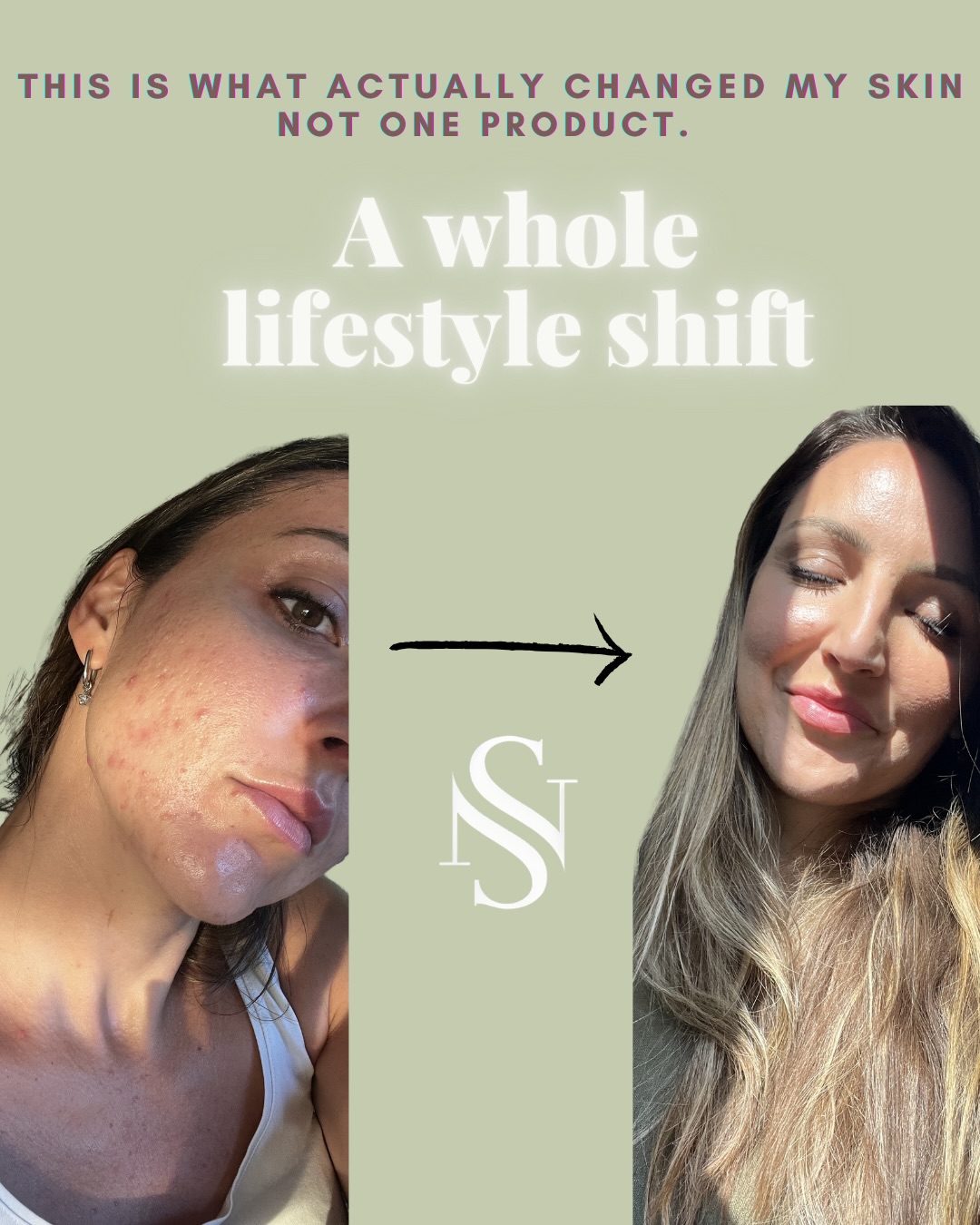 Small steps, real progress❤️
This isn’t “perfect skin” and honestly, I don’t need it to be.My skin still has imperfections, texture, days where it feels more sensitive… but compared to where I started, I’ve never felt better in my skin like I do now🥲.
The real change happened when I stopped chasing quick fixes and started understanding the cause of my acne (hormones, stress, lifestyle, and diet )because everything shows through the skin.
I focused on rebuilding healthy, strong skin from within:💊 Supportive supplements
🥗 Balanced diet & lifestyle changes
🧴 Targeted skincare
💉 Professional treatments
☀️ Daily SPF & long-term habits
🏋️♀️ Gym and movement
Once you learn to listen to your skin, you know what it truly needs✨
If you’re on a similar journey, save this post and be patient with yourself-healing skin takes time🌿⌛️
@hollandandbarrett
@theordinary
@ankhway.life
@obagimedical
@prxt33_uk
@vitaran_uk
@larocheposay