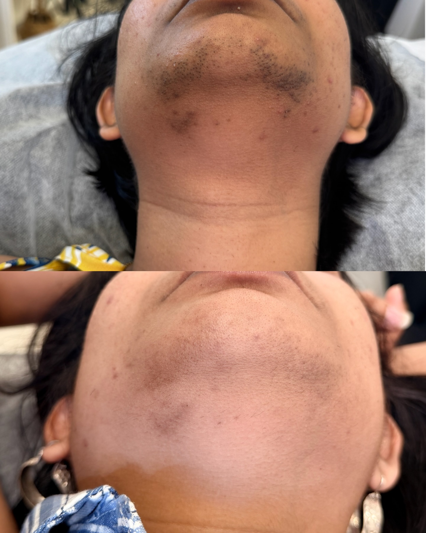 Laser Hair Removal โก๏ธ