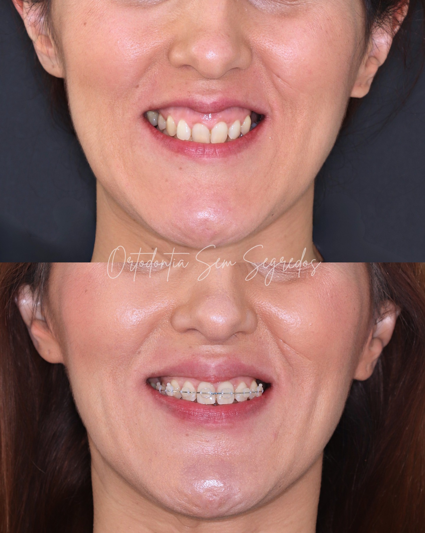🎯🦷 Intrusão do setor anterior superior com mini-implantes.
Neste caso clínico, a ancoragem esquelética permitiu:
✔ corrigir o sorriso gengival
✔ controlar a sobremordida
✔ resolver o torque negativo dos incisivos superiores
✔ melhorar o suporte labial da paciente
Tudo isto com controlo biomecânico, previsibilidade e sem recorrer a cirurgia.
É isto que a ancoragem esquelética bem aplicada consegue fazer — quando há estratégia por trás da mecânica.
Se queres aprender a planear e executar este tipo de abordagens com segurança, vem dominar a técnica no Curso Mini-implantes e MARPE Sem Segredos nos dias 16, 17 e 18 de abril.
📍 Link na bio.