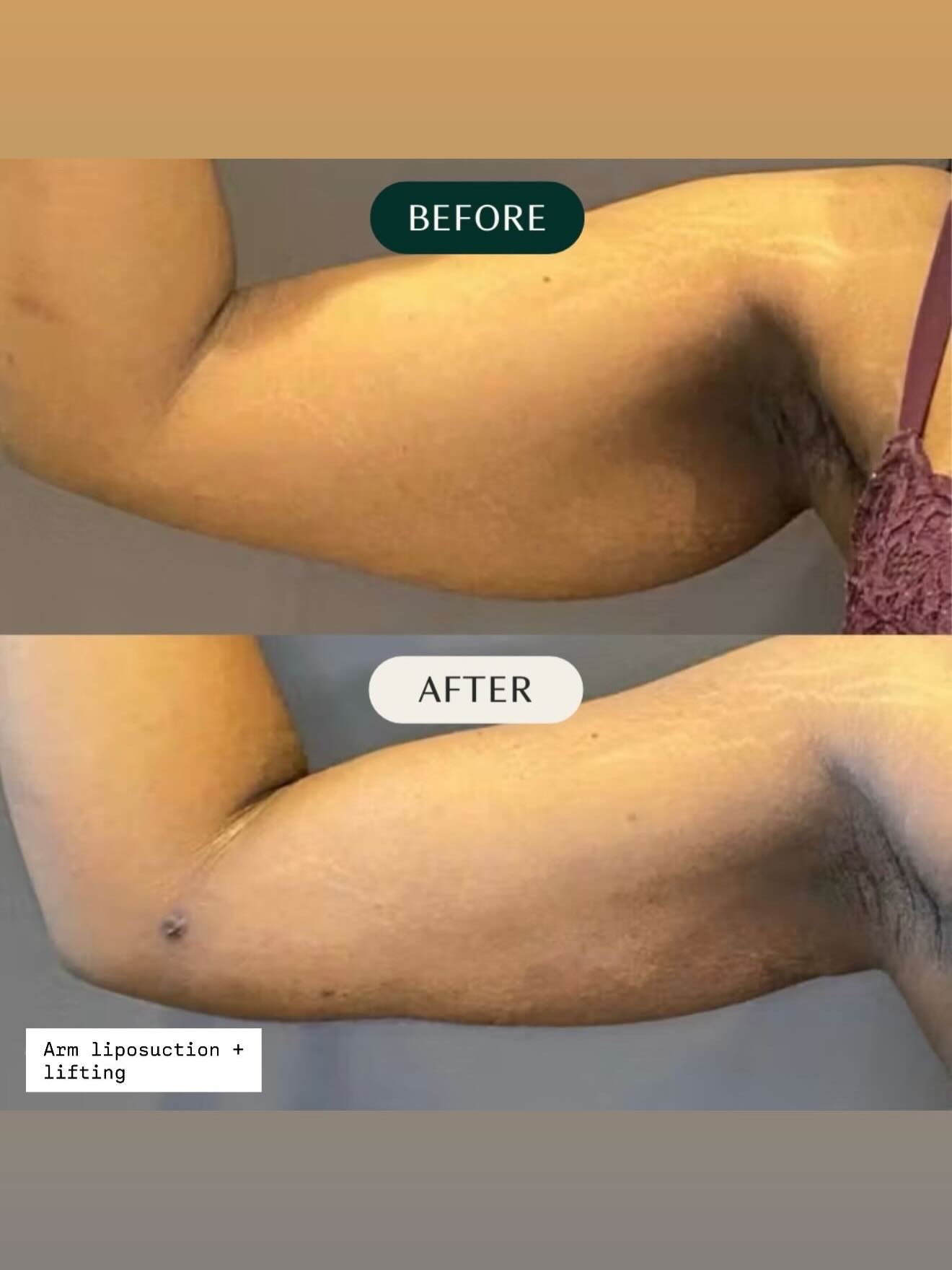 Arm Liposuction 360 + lifting arm .
VietNam Medical Tourism. With Rose
#liposucción #liposuccion #mummymakeover