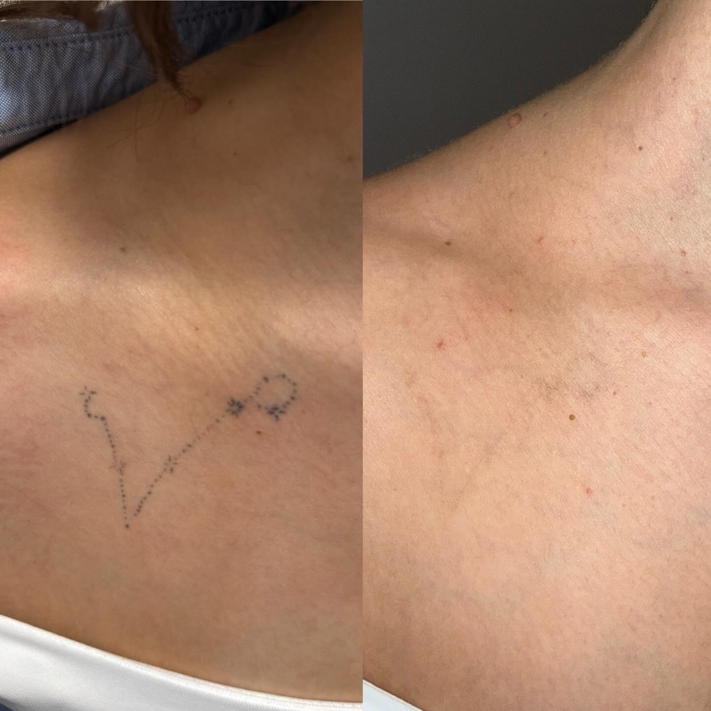 Tattooentfernung mit Curas Hyb… Tattooentfernung mit Curas Hyb…