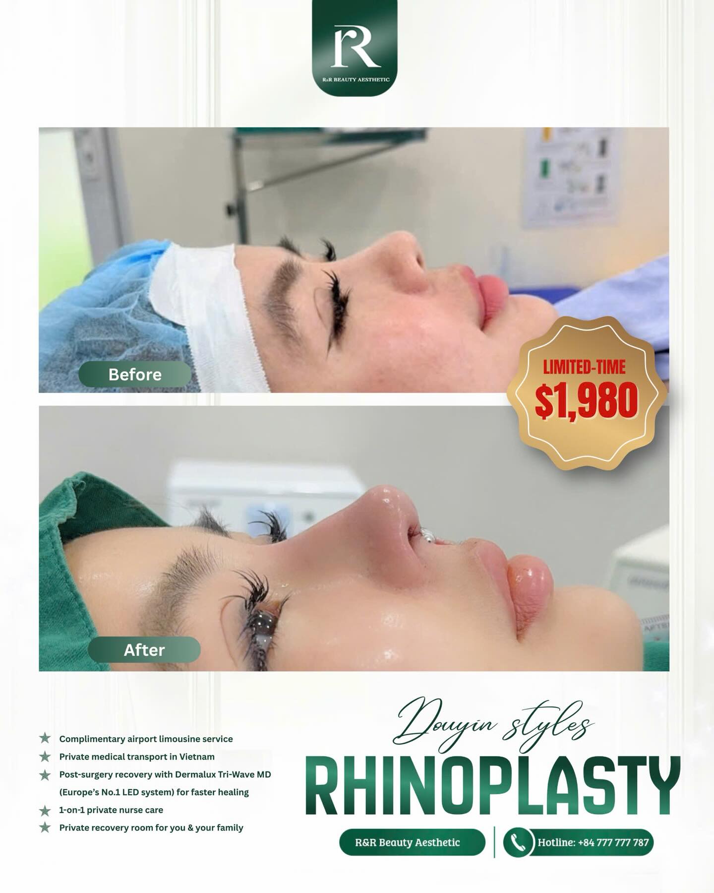 ✨ FULL STRUCTURAL RHINOPLASTY
Promotion Price: $1,980
✔️ Strong, stable nasal structure
✔️ Elegant bridge with smooth contours
✔️ Balanced tip projection and definition
✔️ Feminine, soft profile that complements facial features
✔️ Designed for durability, not temporary beauty
💎 Why choose Full Structural Rhinoplasty at RR ?
– Performed by experienced, board-certified aesthetic doctors
– Advanced structural technique for long-term stability
– Reduced swelling & faster recovery with European light therapy
– 1:1 personalized consultation & aftercare
– International-standard clinic & private recovery services
🌟 Limited-time promotion: $1,980
A refined nose. A confident profile. A beauty that lasts.
📩 DM RR Beauty to secure your consultation today.
.
.
.
#structuralrhinoplasty #rhinoplasty #nosejobclinic #rrbeautyaesthetic #facialharmony
full structural rhinoplasty promotion nose job clinic vietnam advanced rhinoplasty feminine nose design long lasting nose surgery rr beauty aesthetic rhinoplasty recovery