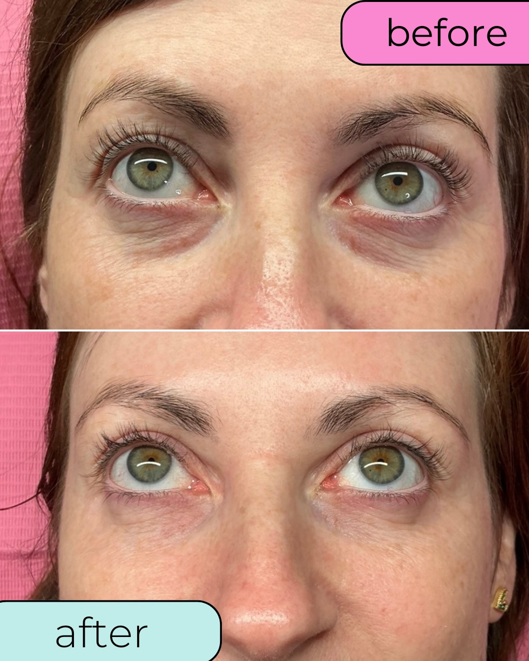 What 2 under eye polynucleotide sessions can do for your dark circles and fine lines 🙌🏽
3rd and final session complete today - I cannot WAIT to see the full result 👀