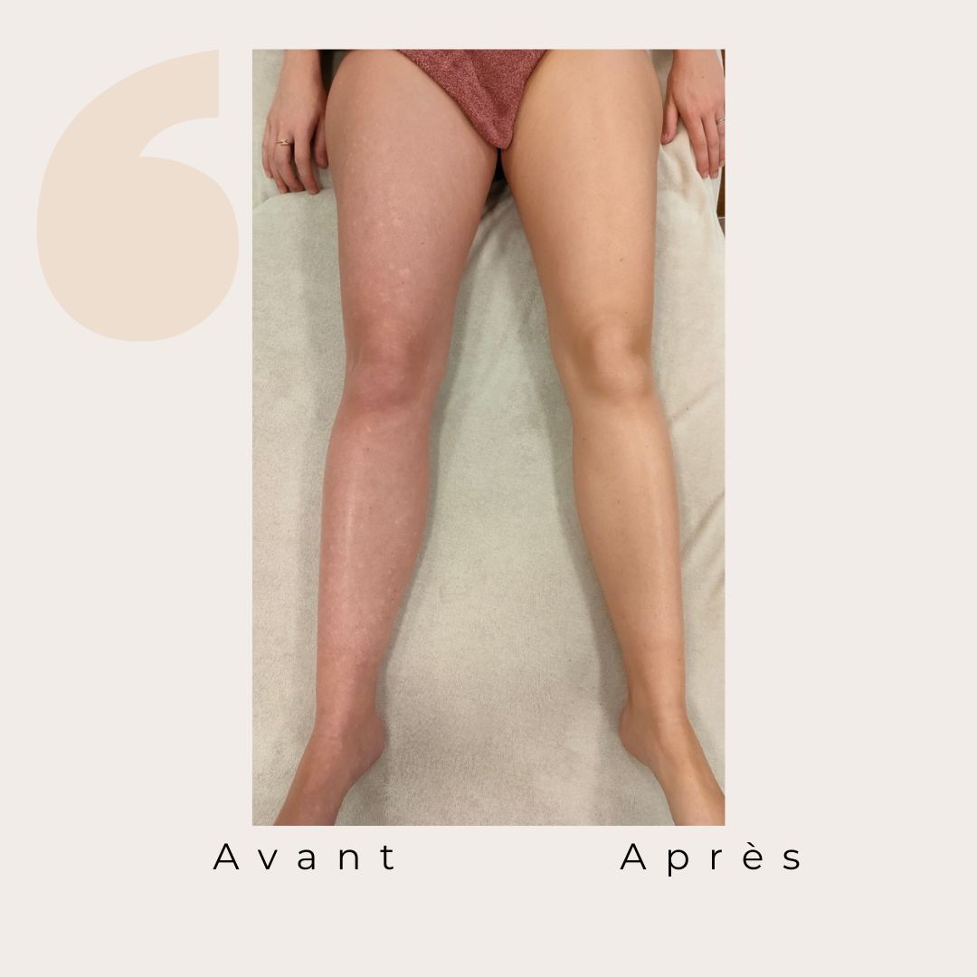 ✨ Avant / Après – Drainage lymphatique Renata França ✨
Dès la première séance, le corps réagit.
Des jambes visiblement plus légères, un galbe redessiné et une sensation immédiate de bien-être 🌿
Le drainage lymphatique Renata França agit en profondeur pour :
✨ stimuler la circulation lymphatique
✨ réduire la rétention d’eau
✨ affiner et détoxifier les jambes
✨ apporter une sensation de légèreté durable
Résultat visible, ressenti immédiat 🤍
Chaque corps est unique, les résultats peuvent varier, mais la légèreté, elle, est toujours au rendez-vous ✨
#drainagelymphatique #renatafranca #avantapres #jambeslegeres #retentiondeau #bienetre #soincorps #detox #momentpoursoi
