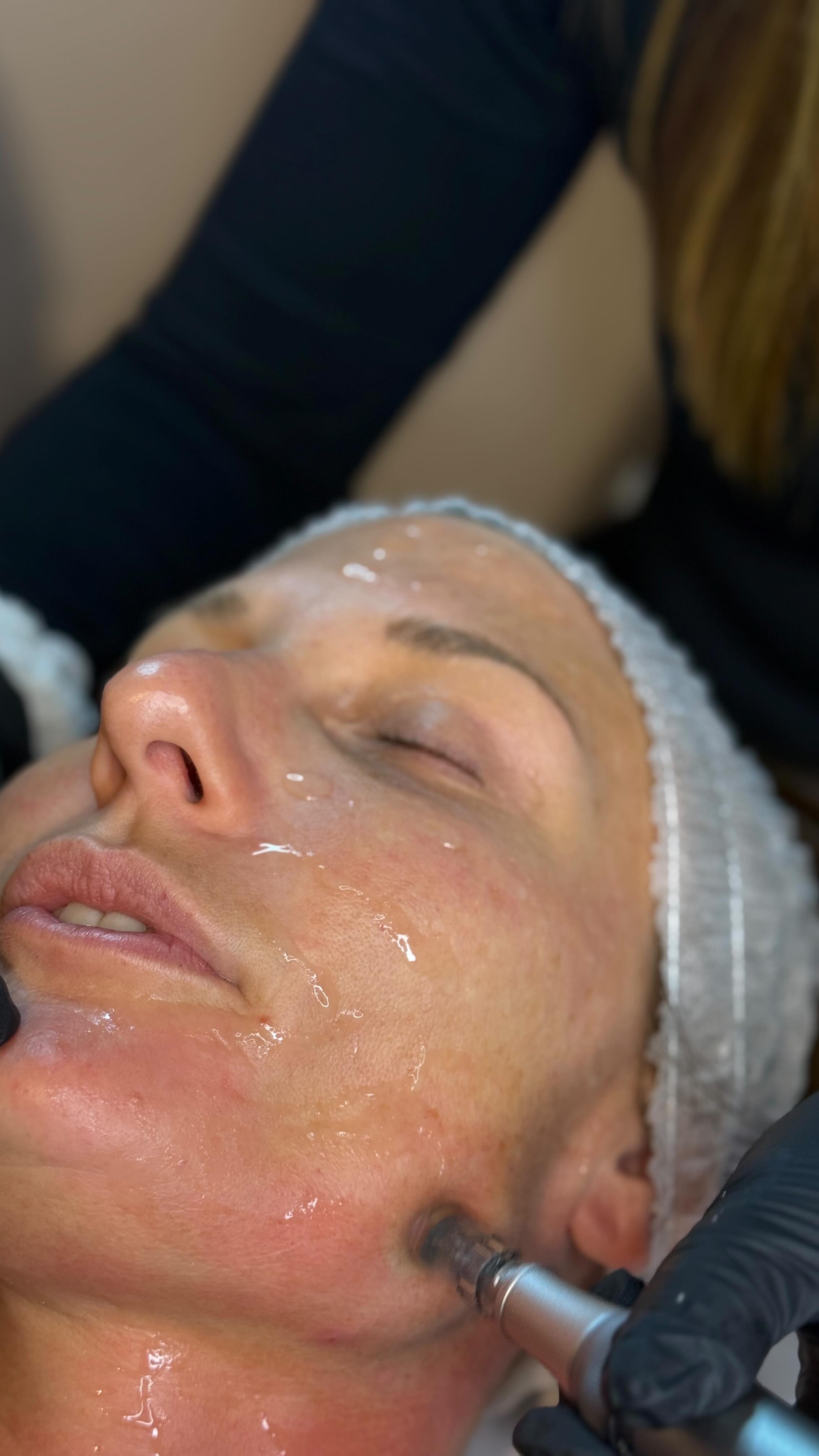 Microneedling isn’t about chasing glow. It’s about rebuilding skin properly.
A lot of treatments work on the surface. Microneedling works underneath it.
By creating controlled micro-channels in the skin, we stimulate your body’s natural repair response. That means new collagen. Stronger structure. Healthier skin over time. Not just temporary brightness.
It’s ideal if you’re dealing with:
Acne scarring that hasn’t shifted
Texture that makeup won’t smooth
Fine lines creeping in
Skin that feels thin or tired
Enlarged pores
Post-inflammatory pigmentation
The real magic? Results build gradually. Your skin improves week after week as collagen remodels beneath the surface.
This isn’t an instant filter.
It’s long-term skin investment.
If you’re serious about improving your skin, microneedling is where we start.
DM to book or ask if it’s right for you.
#microneedlingcheltenham #skinremodeling #collageninduction #nineteenbeauty #cheltenhamskinclinic longtermskinresults