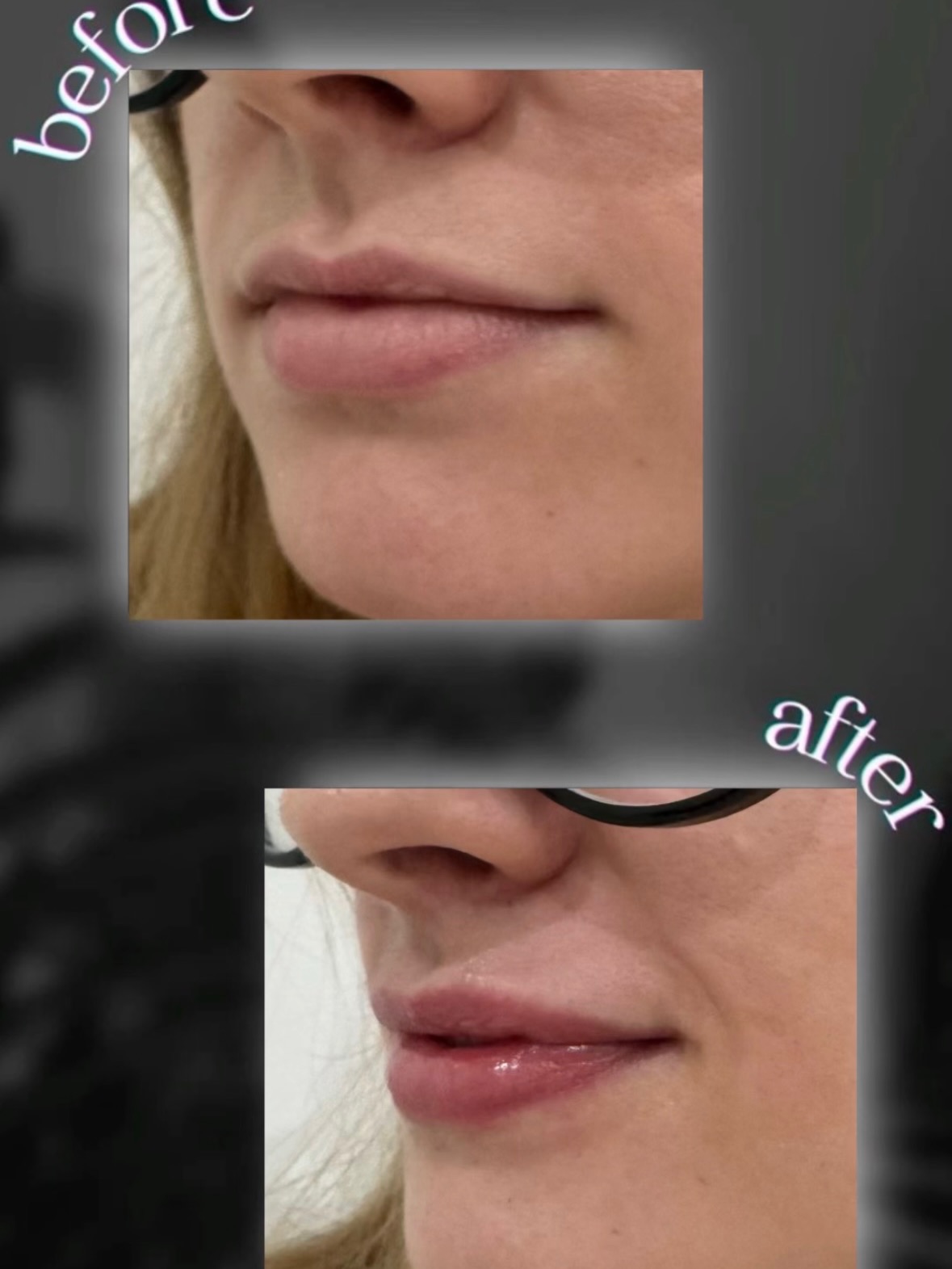 Subtle. Sophisticated. Perfectly balanced ✨
This stunning result was achieved using Teoxane dermal filler — expertly placed to enhance natural contours and bring perfect profile harmony.
Teoxane’s advanced formulation blends seamlessly with your skin, restoring volume while keeping every expression beautifully soft and natural 💫
Because true artistry isn’t about changing your features — it’s about refining what’s already there.
📅 DM us to book your consultation today
#Teoxane #DermalFiller #FacialBalancing #ProfilePerfection #AestheticClinic