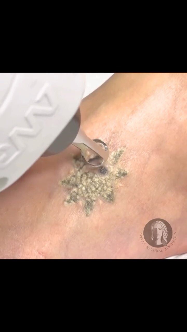 .
âïžð
ðððððððâïž
The white effect you see forming on the tattoo is known as âðð«ðšð¬ðð¢ð§ð â.
This occurs when the laser energy interacts with the pigment, creating a temporary whitening of the skin as microscopic gas bubbles form. Itâs a completely expected response and a sign the ink is absorbing the energy exactly as intended.
As the ink gradually fades over a course of treatments, youâll typically notice the level of frosting becomes less pronounced, simply because there is less pigment present to react.
The frosting itself fades within minutes, while the real work continues beneath the surface as your bodyâs lymphatic system clears the fragmented pigment over the coming weeks.
ð www.appearnaturalaesthetics.com
ð 07423 109237
ð§ info@appearnaturalaesthetics.com
ð· POA - from £45 per session
ðHayes, Bromley BR2 7EB
#tattooremovalsouthlondon #tattooremovalspecialists #lasertattooremoval #allwhitelaser #tattooremoval
@allwhitelaser