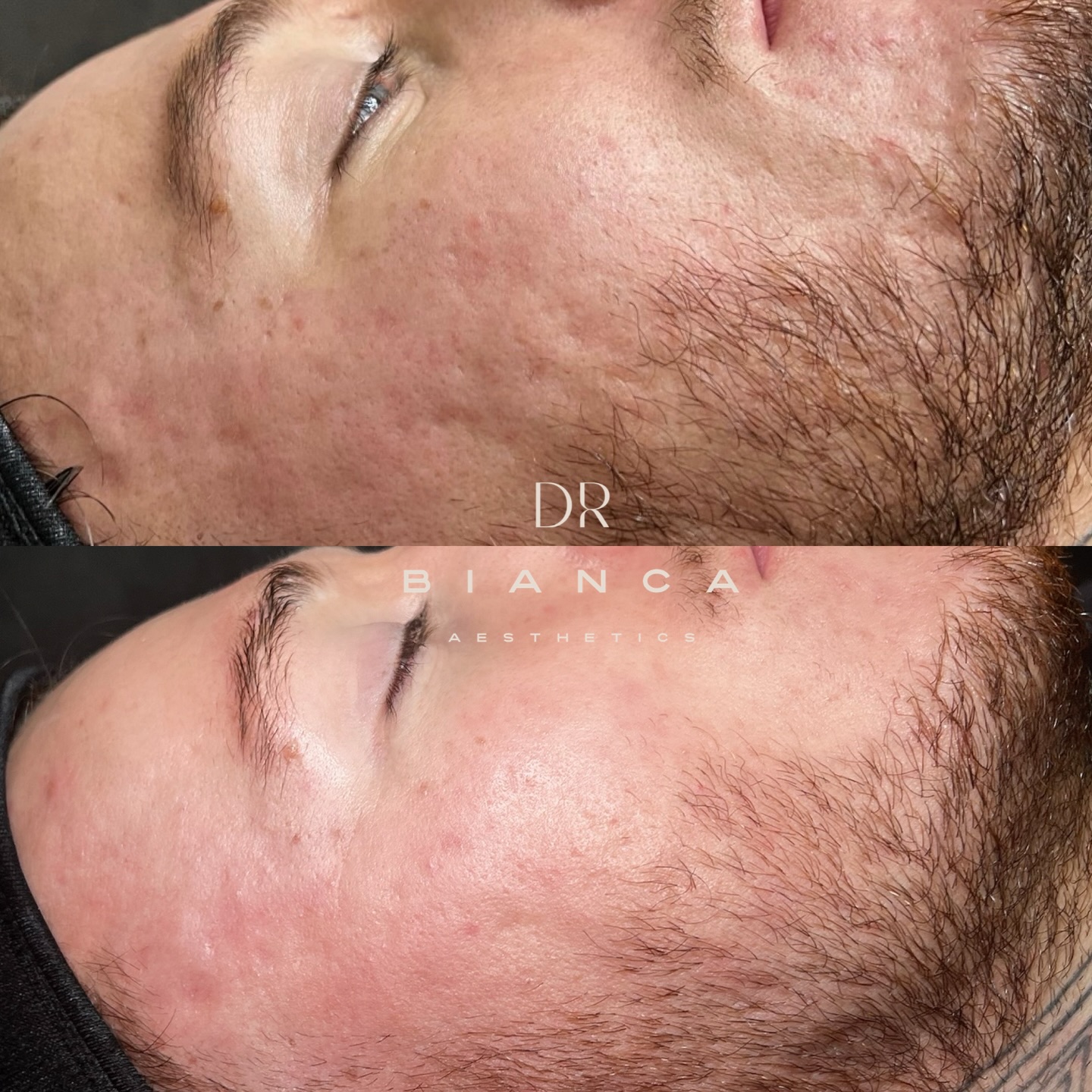 Month 4 of this acne-scar skin journey ✨
After 3 sessions of @imedpen_microneedling + 1 @phformulauki TCA peel, we’re already seeing smoother texture, softened scarring, and calmer, more even skin. This is a reminder that meaningful skin change takes time, consistency, and trust in the process.
We’re not finished yet… the best is still to come 💫
If you’re struggling with acne scarring and want a personalised plan, I’m based in Washington — more details at www.doctorbianca.co.uk
#SkinJourney #AcneScarTreatment #Microneedling #TCAPeel #MedicalAesthetics TrustTheProcess