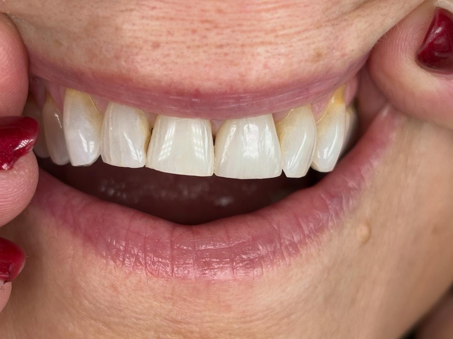 Zirconia Buccal Cutback with In-Lab Custom Shade by our own Master Ceramist, JP.
And one beautiful smile restored, on a very happy patient. Because… is that not what it is all about?
Precision Esthetics. Your Choice Dental Laboratory led by Master Dental Technicians.