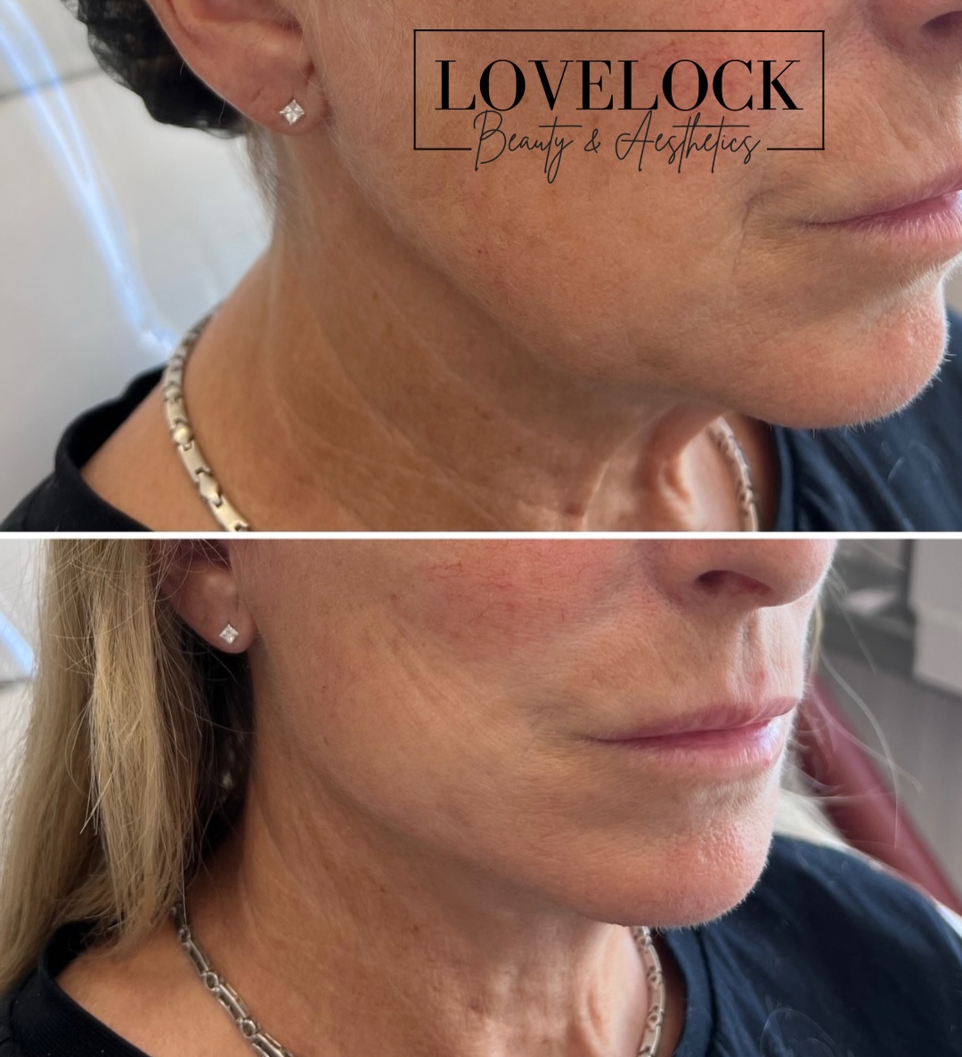 The results speak for itself
A sculpted jawline can completely transform facial balance and definition ✨
Jawline contouring with dermal filler is a non-surgical treatment designed to enhance structure, improve symmetry, and restore lost definition along the lower face.
✨ Benefits of jawline sculpting:
• Creates a sharper, more defined profile
• Enhances facial proportions and harmony
• Supports jowls and softens lower-face heaviness
• Can subtly lift the lower face
• Immediate, natural-looking results
• Minimal downtime
Perfect for anyone wanting a more contoured, youthful appearance without surgery.
Results are tailored to your unique facial anatomy for a refined, not “overdone” finish.
📍Book your consultation today to see if jawline sculpting is right for you.
#warminster #westbury #trowbridge #hilperton #frome