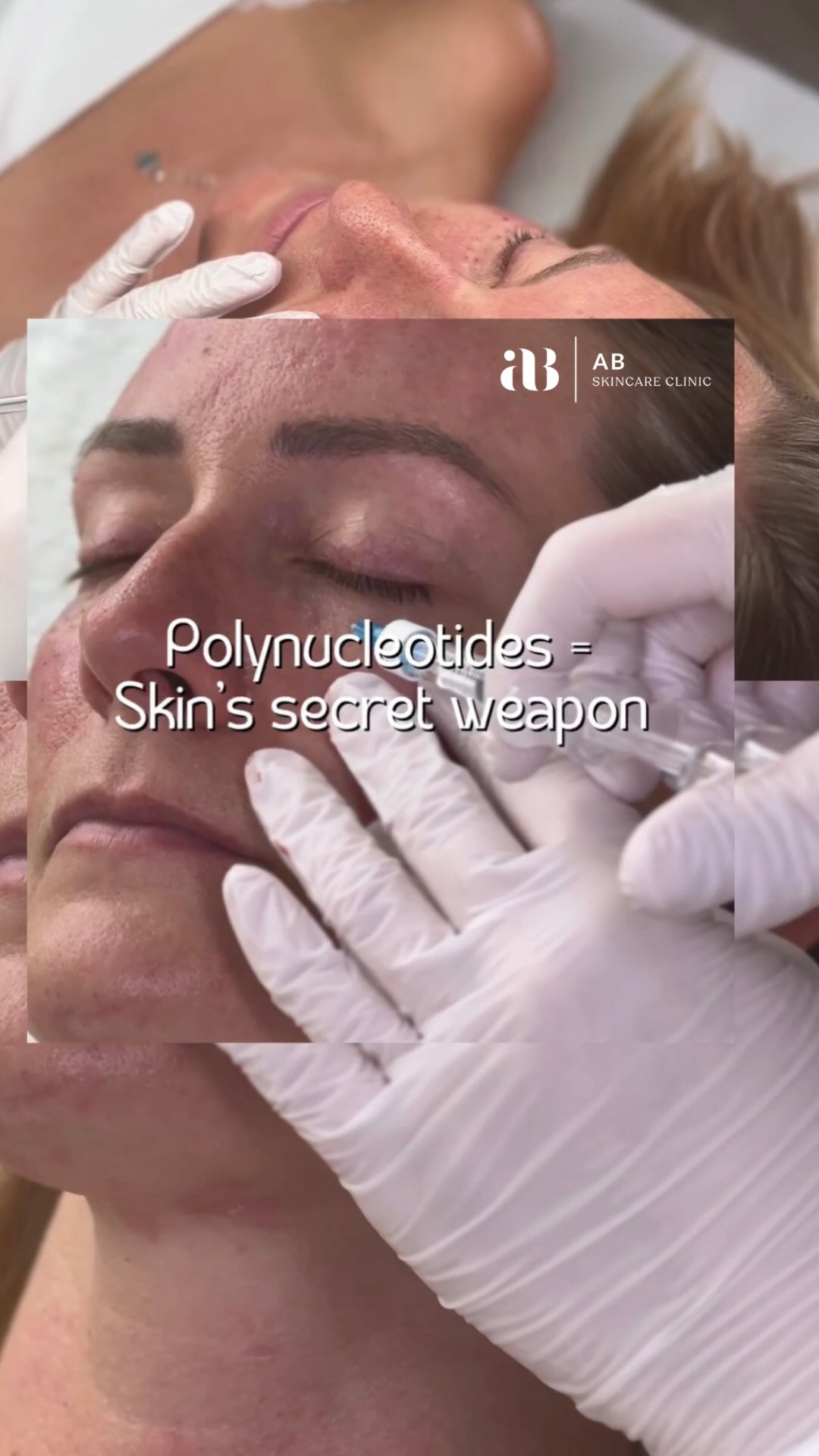 Polynucleotides represent the pinnacle of advanced regenerative therapy โ a sophisticated approach to skin rejuvenation. Biocompatible and bioactive, these intelligent molecules work at a cellular level, stimulating fibroblast activity to support collagen and elastin production. The result is clinically proven regeneration that restores skin architecture from within.
By enhancing dermal integrity and strengthening the skin barrier, polynucleotides promote long-term tissue repair rather than temporary correction.
Scientifically formulated and evidence-based, polynucleotide treatments activate natural repair pathways, delivering luxury results backed by medical science โ where innovation meets timeless skin health.
What you can expect:
โข Improved acne scarring & textural irregularities
โข Visible reduction in fine lines & ageing markers
โข Enhanced skin elasticity & firmness
โข Deep hydration & improved skin quality
โข Stronger skin barrier function
โข Brighter, more even complexion
๐Link in Bio to book in for your barrier building treatment todayโฆ